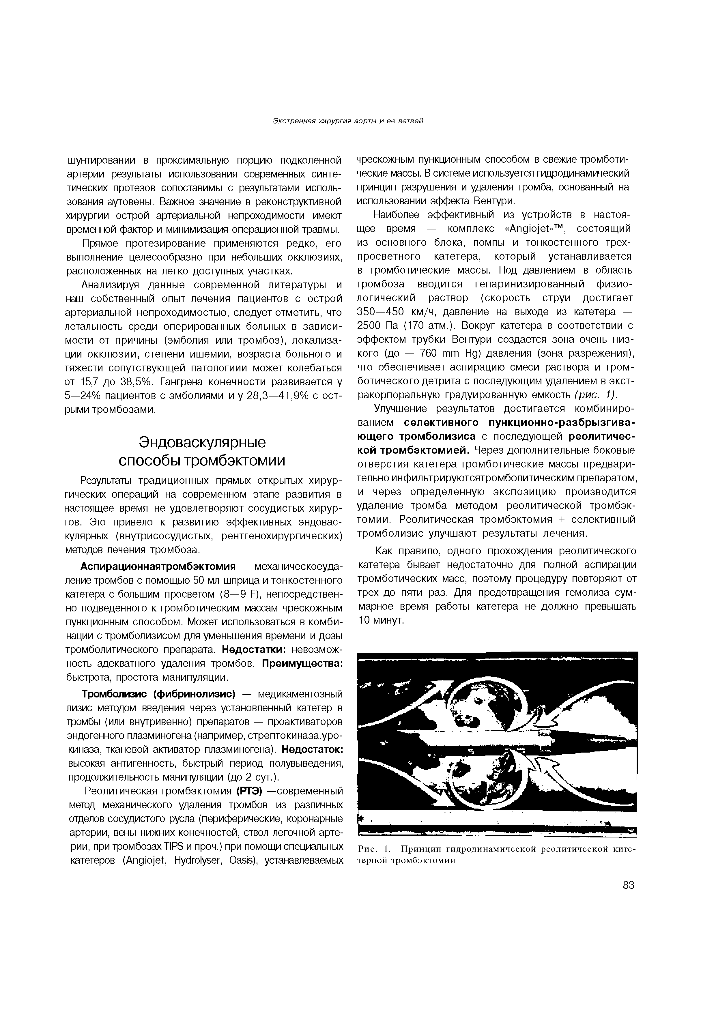 Рис. 1. Принцип гидродинамической реолитической ките-терной тромбэктомии...