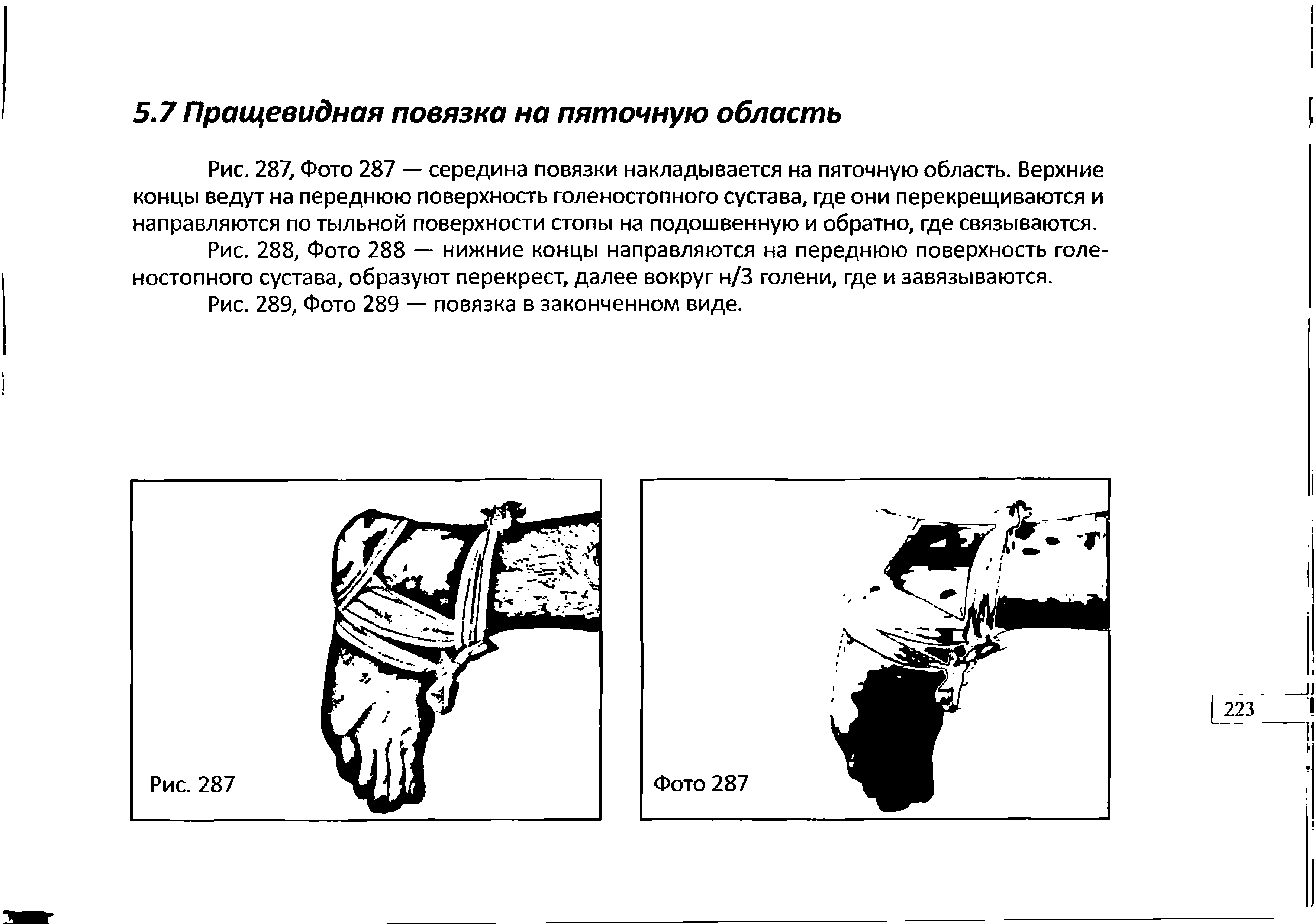 Рис. 287, Фото 287 — середина повязки накладывается на пяточную область. Верхние концы ведут на переднюю поверхность голеностопного сустава, где они перекрещиваются и направляются по тыльной поверхности стопы на подошвенную и обратно, где связываются.