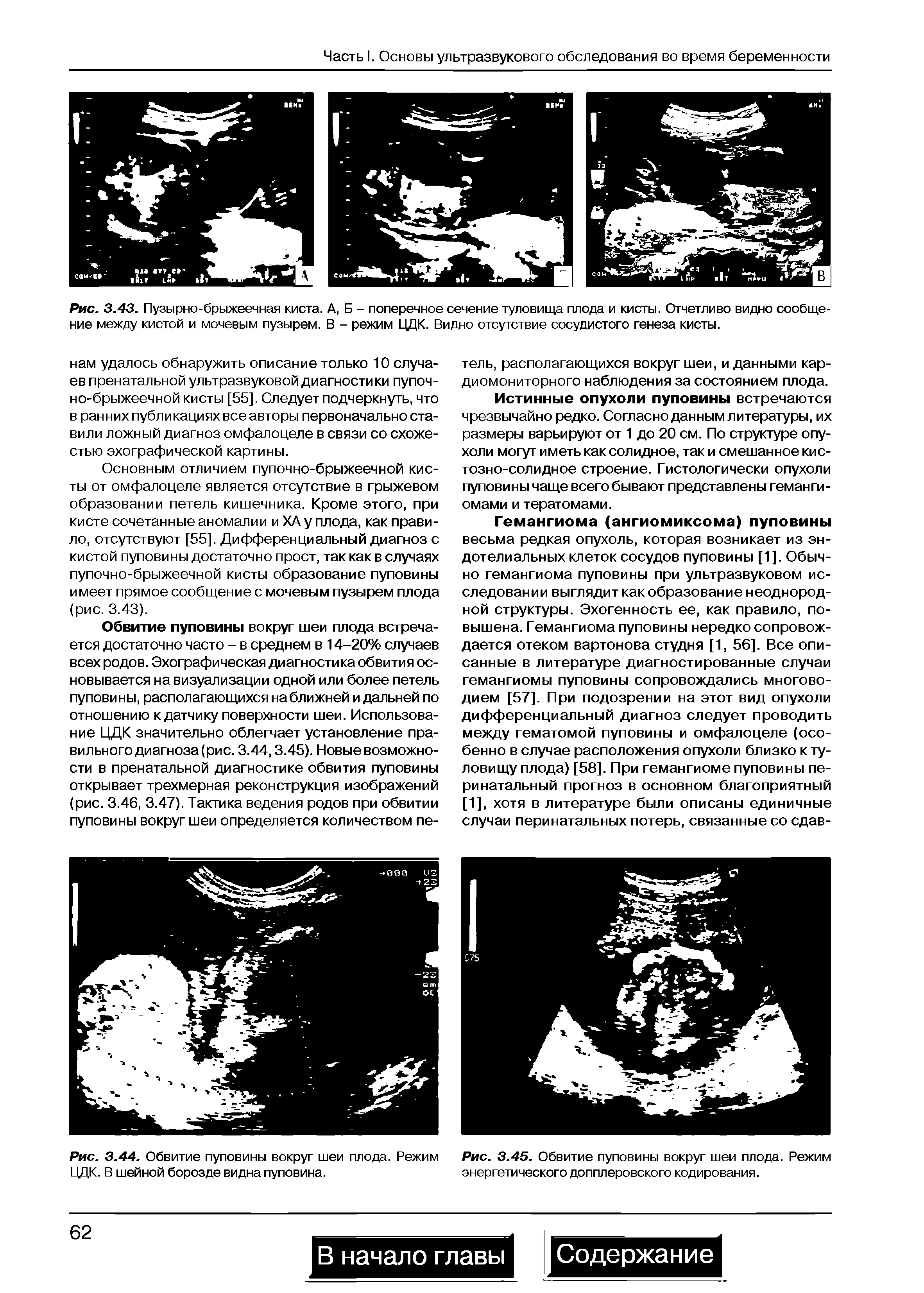 Рис. 3.43. Пузырно-брыжеечная киста. А, Б - поперечное сечение туловища плода и кисты. Отчетливо видно сообщение между кистой и мочевым пузырем. В - режим ЦДК. Видно отсутствие сосудистого генеза кисты.