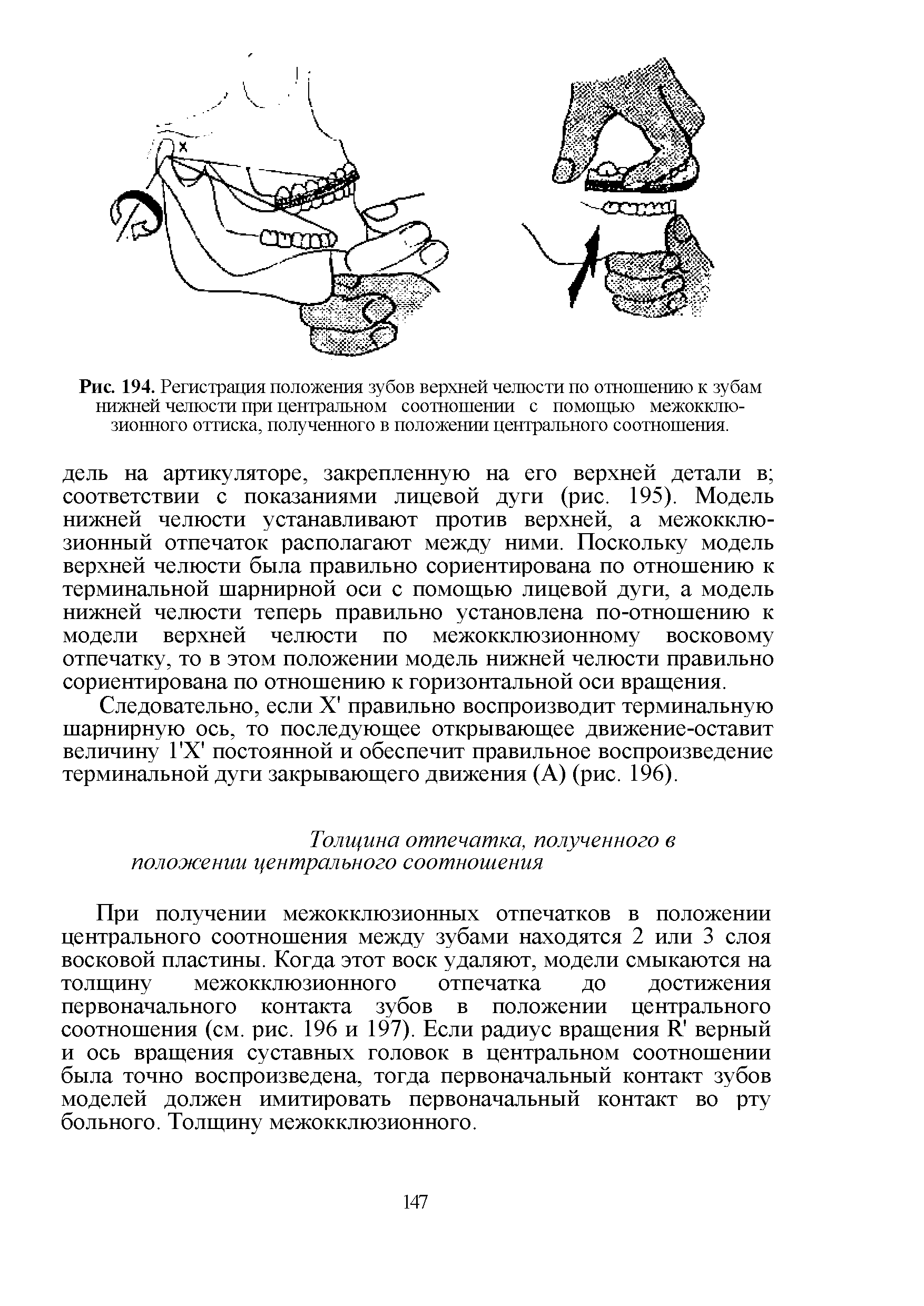 Рис. 194. Регистрация положения зубов верхней челюсти по отношению к зубам нижней челюсти при центральном соотношении с помощью межокклюзионного оттиска, полученного в положении центрального соотношения.