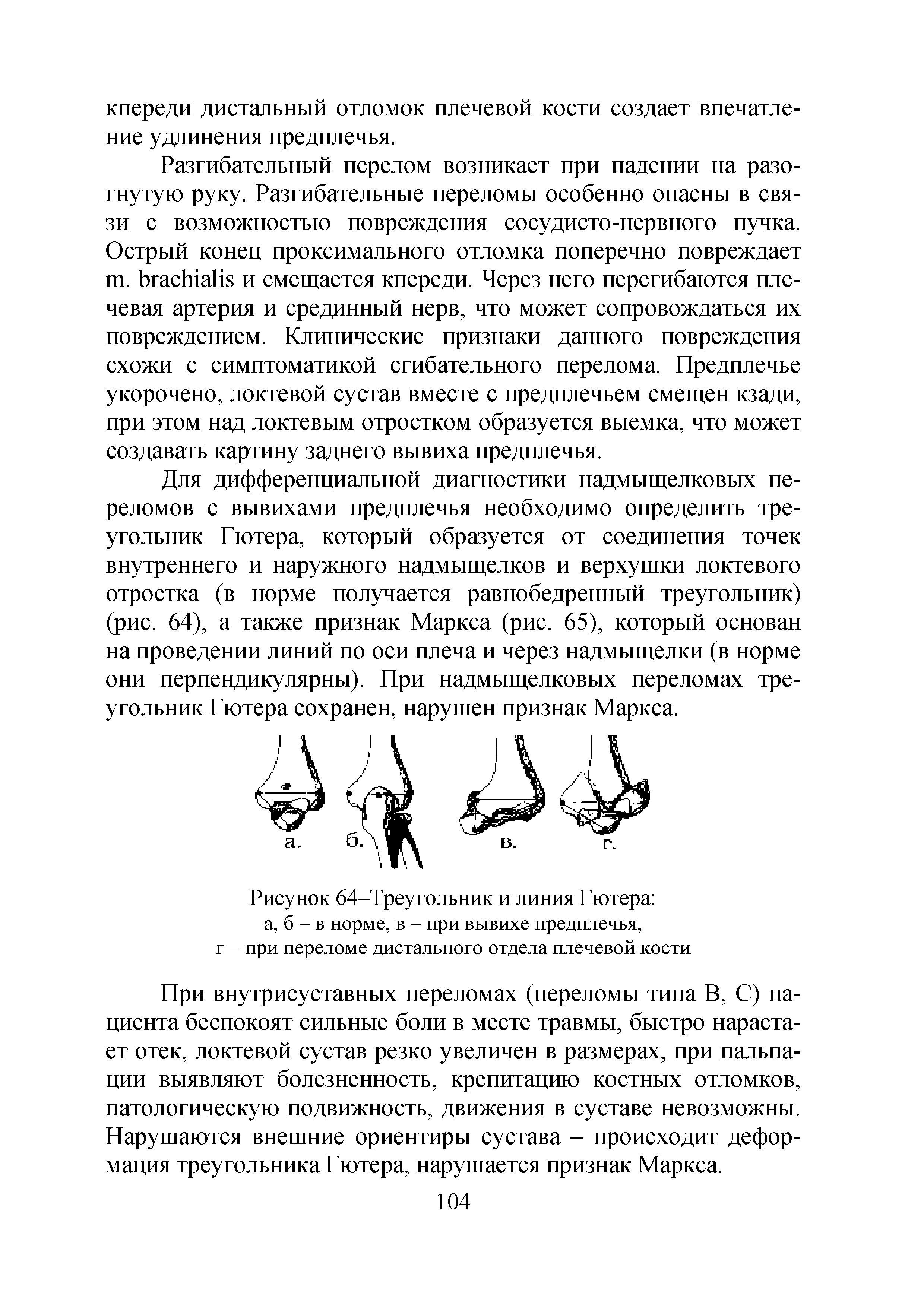 Рисунок 64-Треугольник и линия Гютера а, б - в норме, в - при вывихе предплечья, г - при переломе дистального отдела плечевой кости...