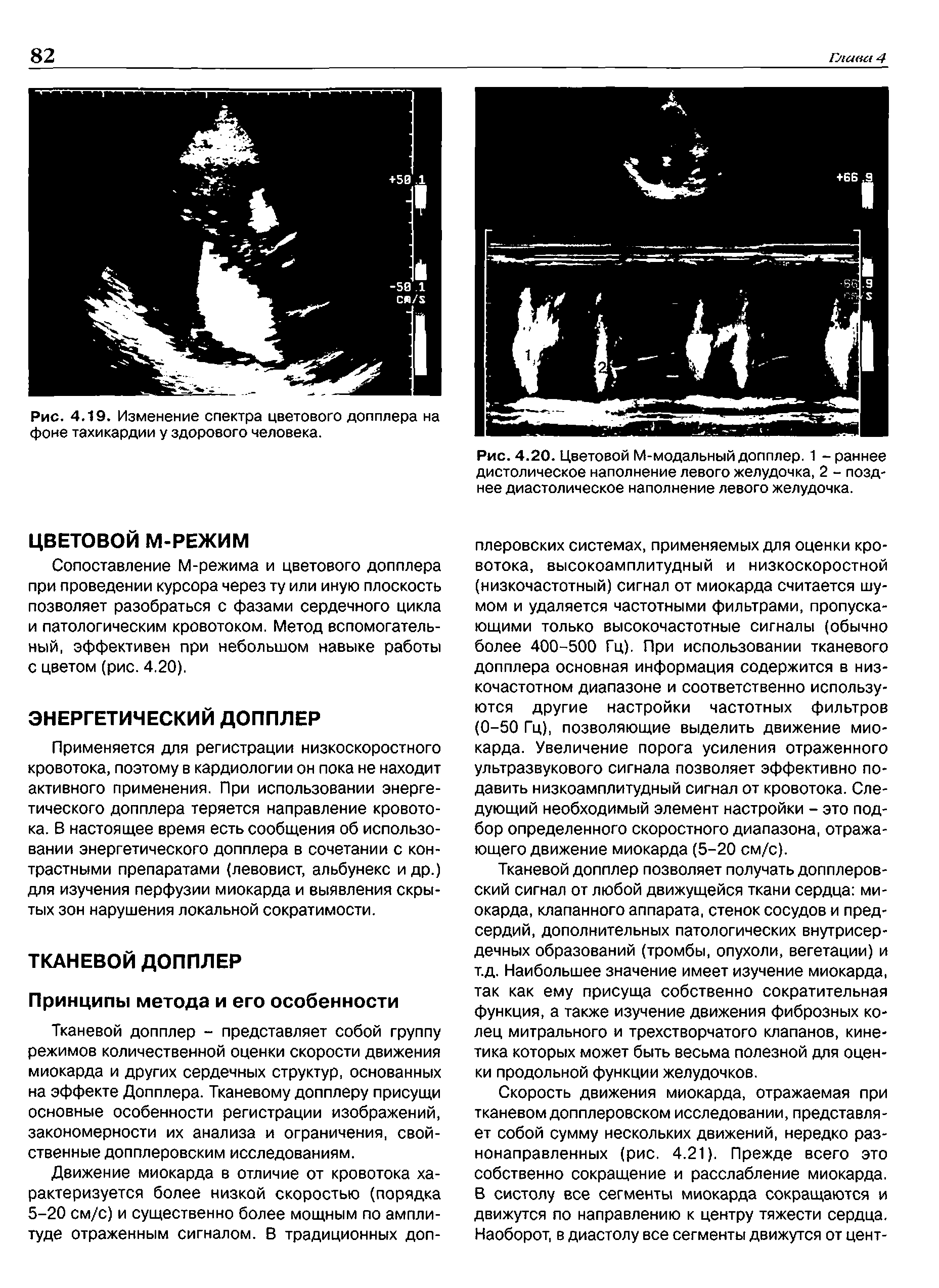 Рис. 4.20. Цветовой М-модальный допплер. 1 - раннее дистолическое наполнение левого желудочка, 2 - позднее диастолическое наполнение левого желудочка.