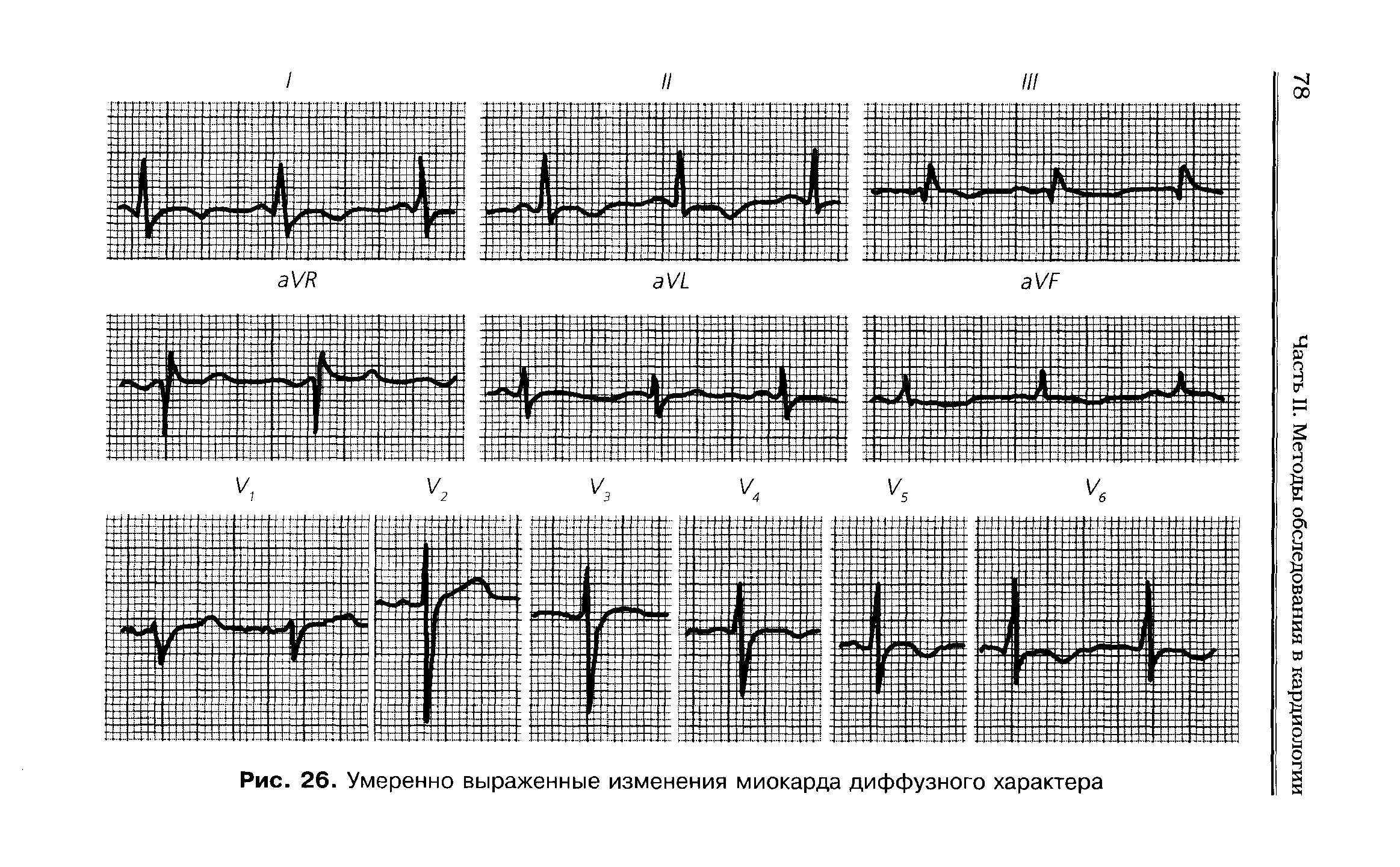 Рис. 26. Умеренно выраженные изменения миокарда диффузного характера...