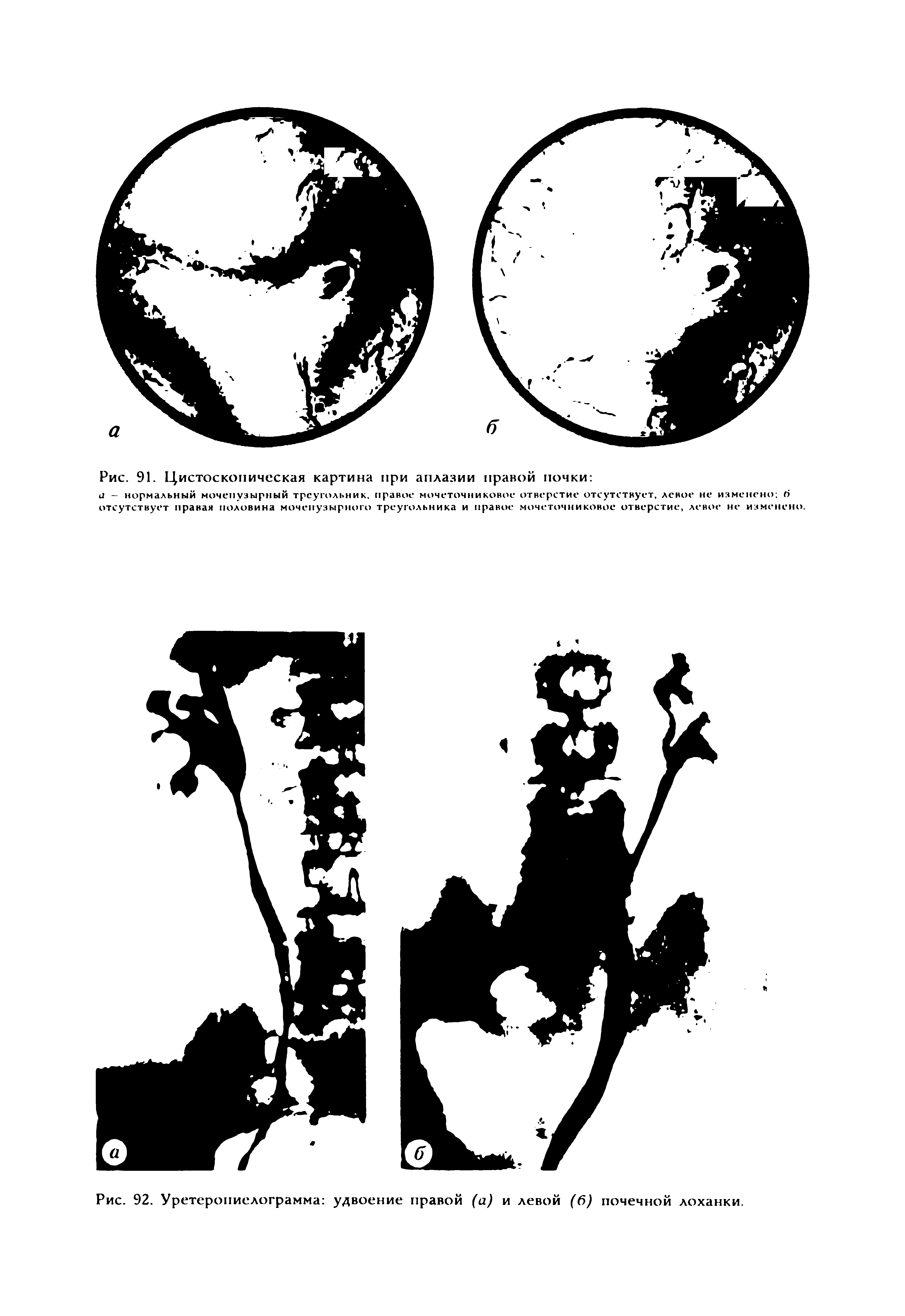 Рис. 92. Уретеропиелограмма удвоение правой (а) и левой (6) почечной лоханки.