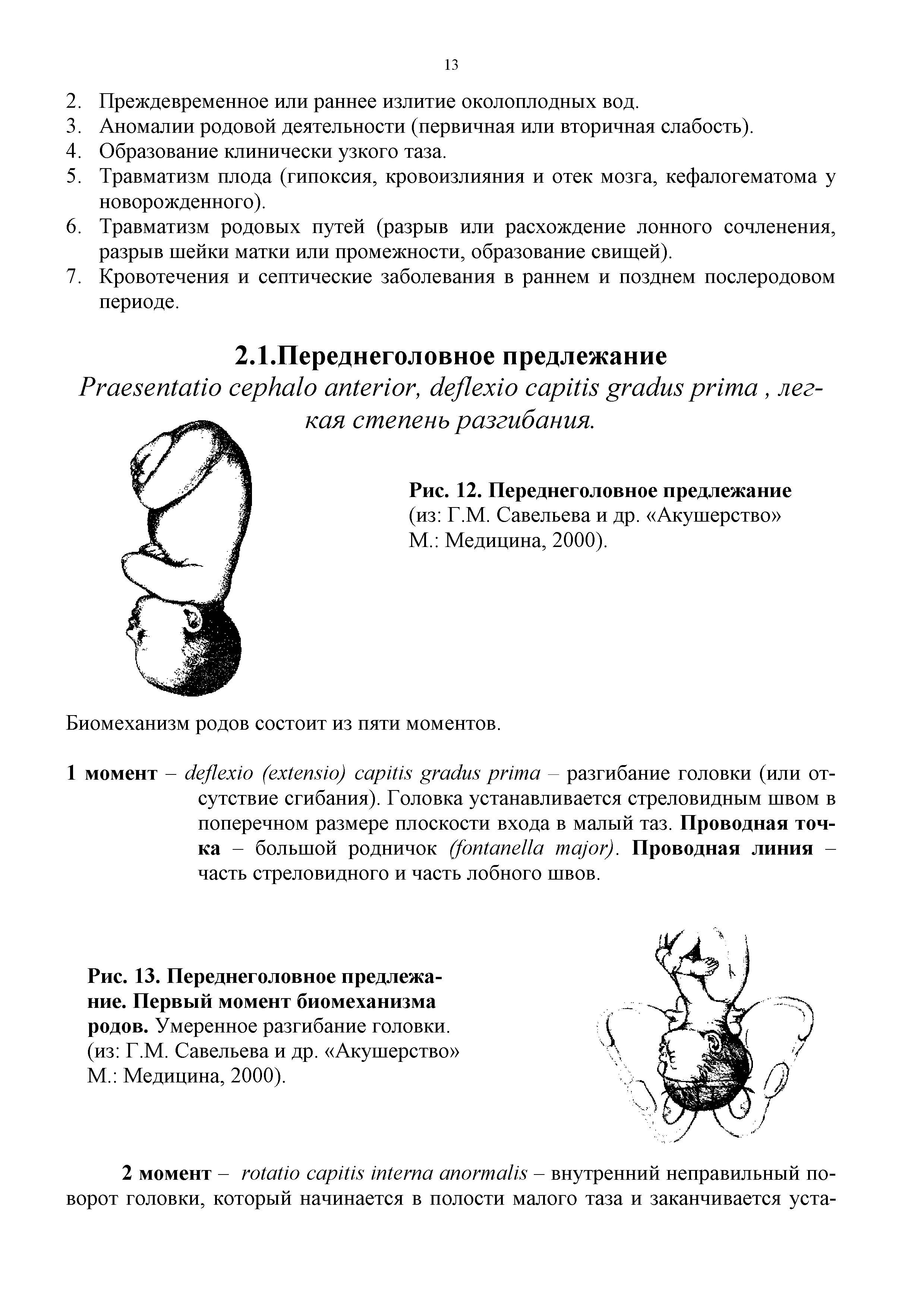 Рис. 13. Переднеголовное предлежание. Первый момент биомеханизма родов. Умеренное разгибание головки, (из Г.М. Савельева и др. Акушерство М. Медицина, 2000).