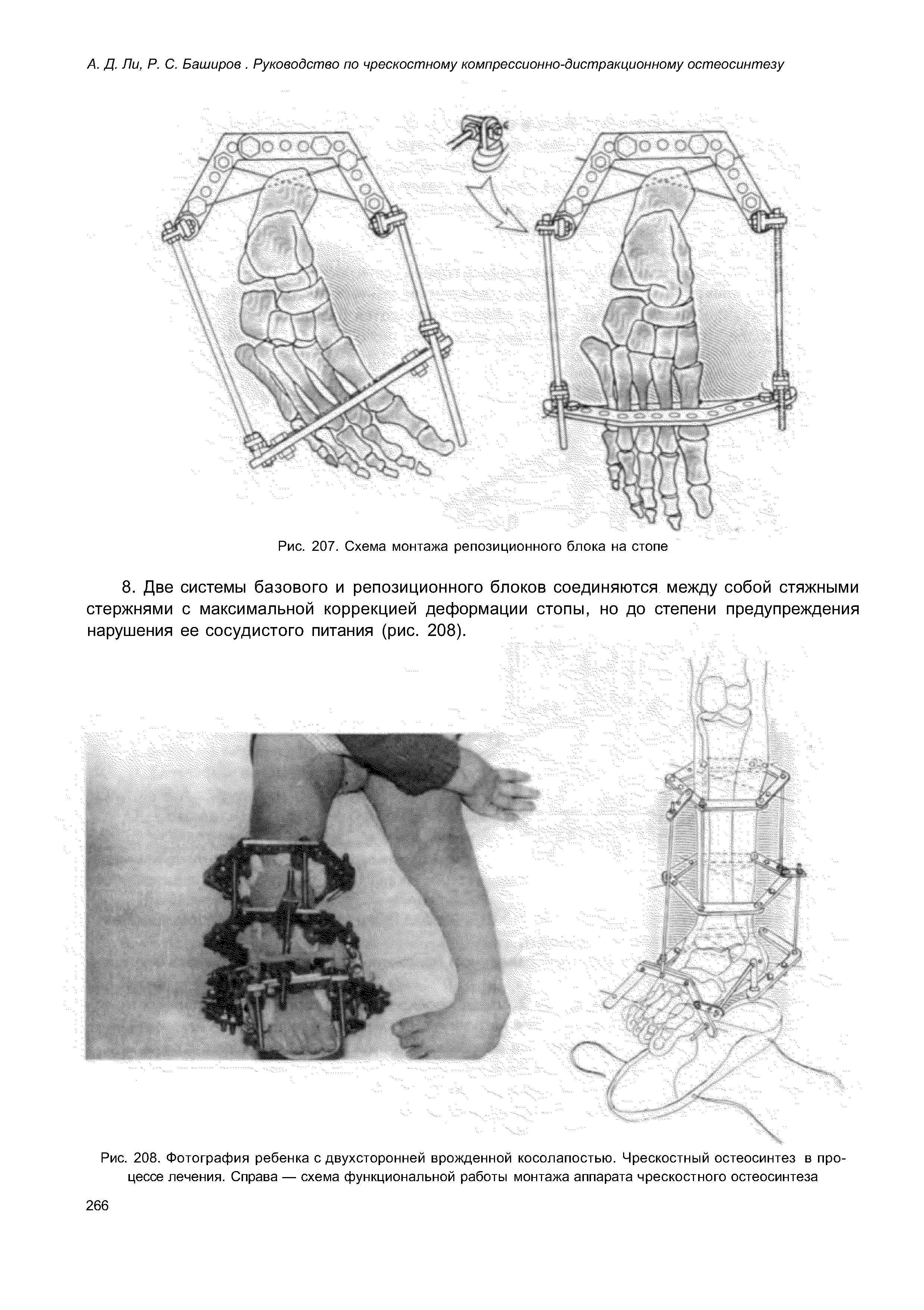 Рис. 208. Фотография ребенка с двухсторонней врожденной косолапостью. Чрескостный остеосинтез в процессе лечения. Справа — схема функциональной работы монтажа аппарата чрескостного остеосинтеза...