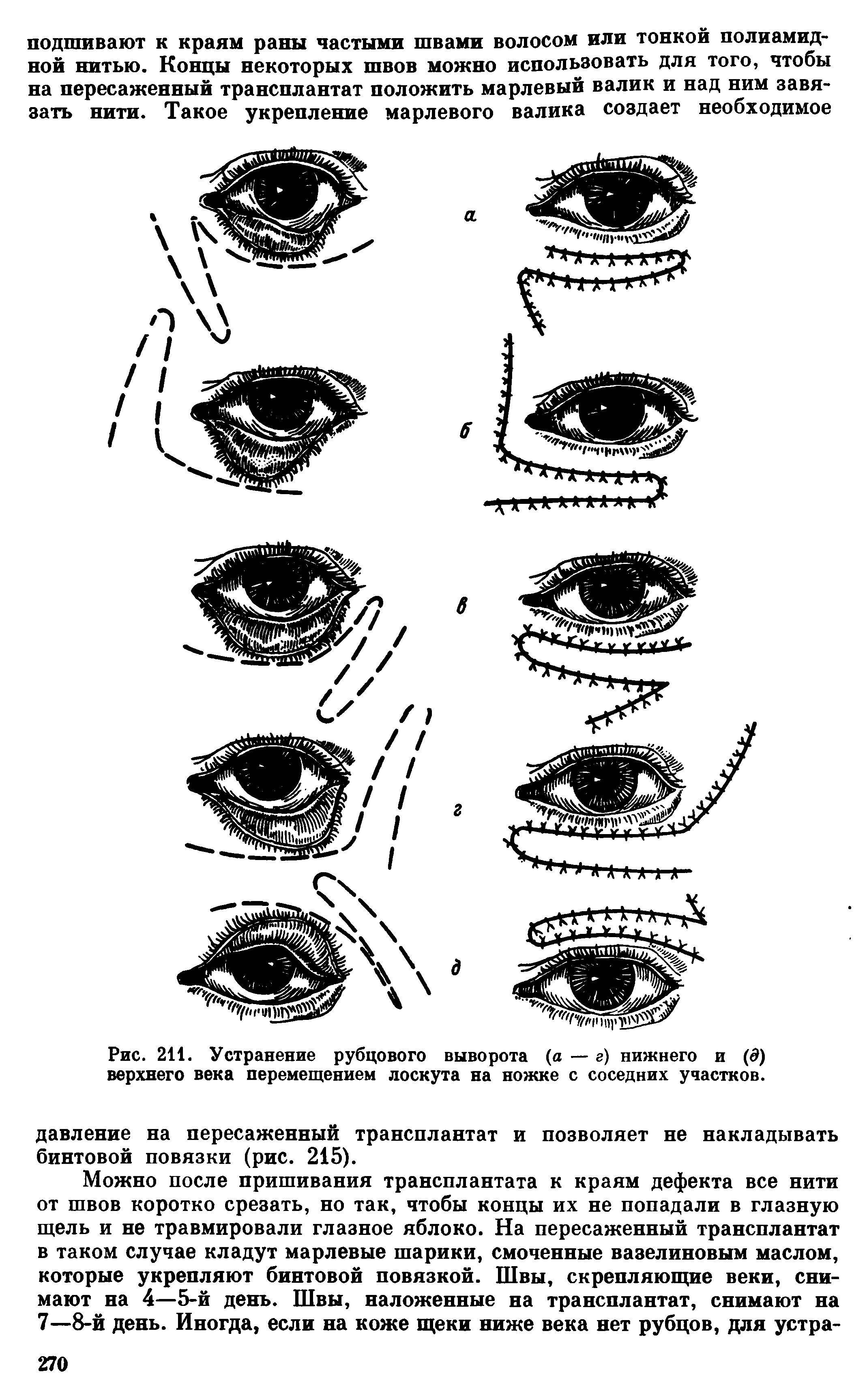 Рис. 211. Устранение рубцового выворота (а — г) нижнего и (д) верхнего века перемещением лоскута на ножке с соседних участков.
