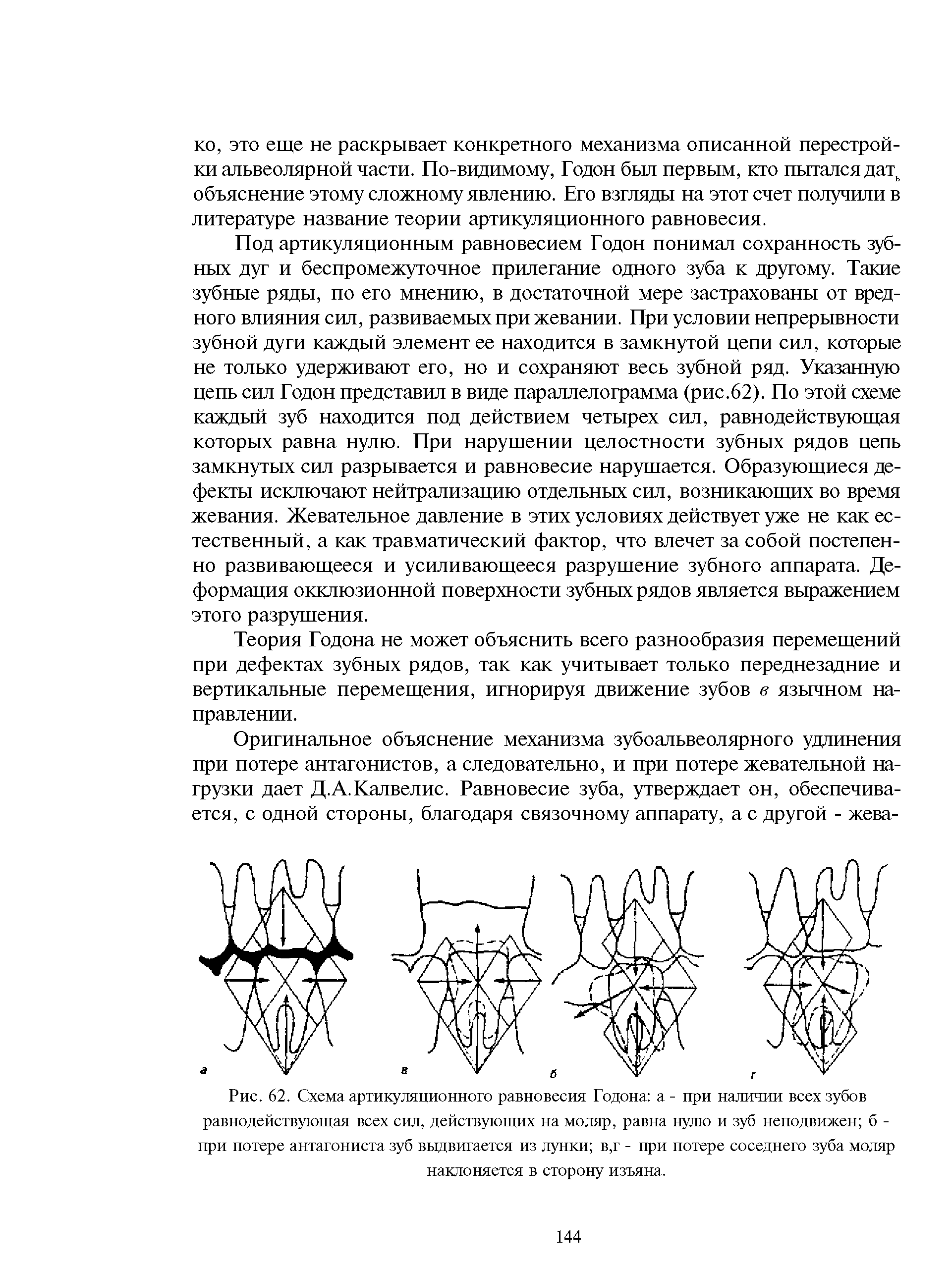 Рис. 62. Схема артикуляционного равновесия Годона а - при наличии всех зубов равнодействующая всех сил, действующих на моляр, равна нулю и зуб неподвижен б -при потере антагониста зуб выдвигается из лунки в,г - при потере соседнего зуба моляр наклоняется в сторону изъяна.