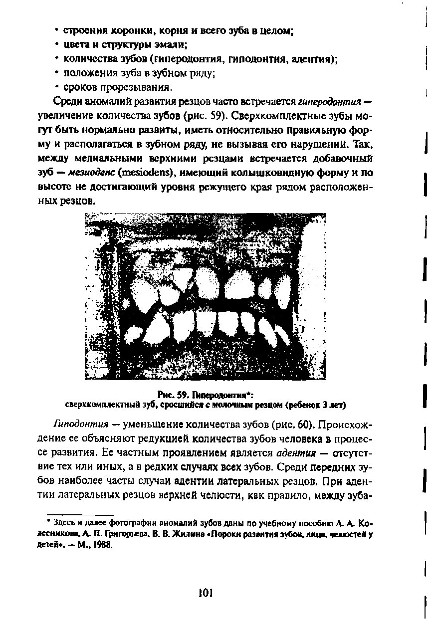 Рис. 59. Птеродмтм сверхкомплектный зуб, сросшийся с молочным резцом (ребенок 3 лет)...