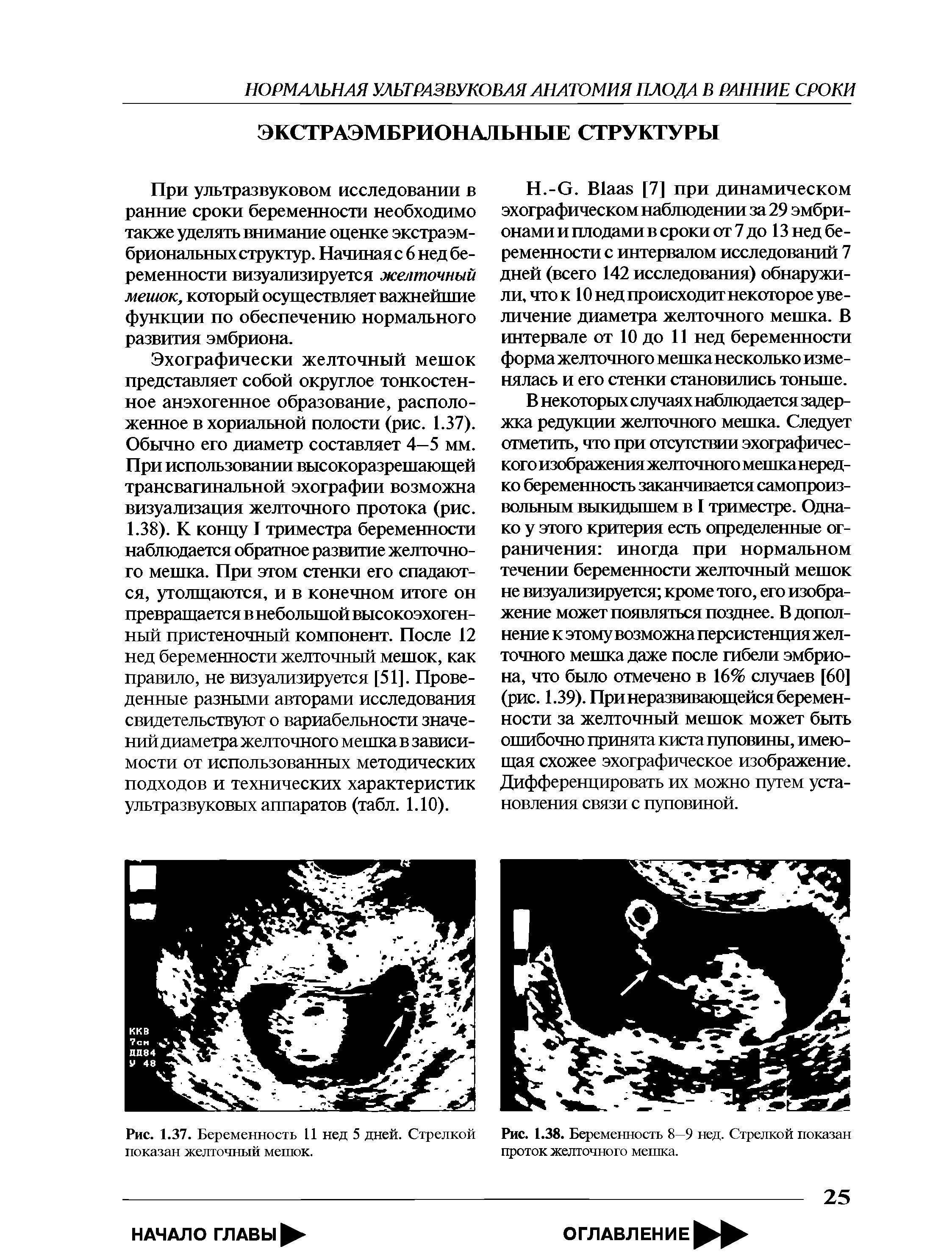 Рис. 1.37. Беременность 11 нед 5 дней. Стрелкой показан желточный мешок.