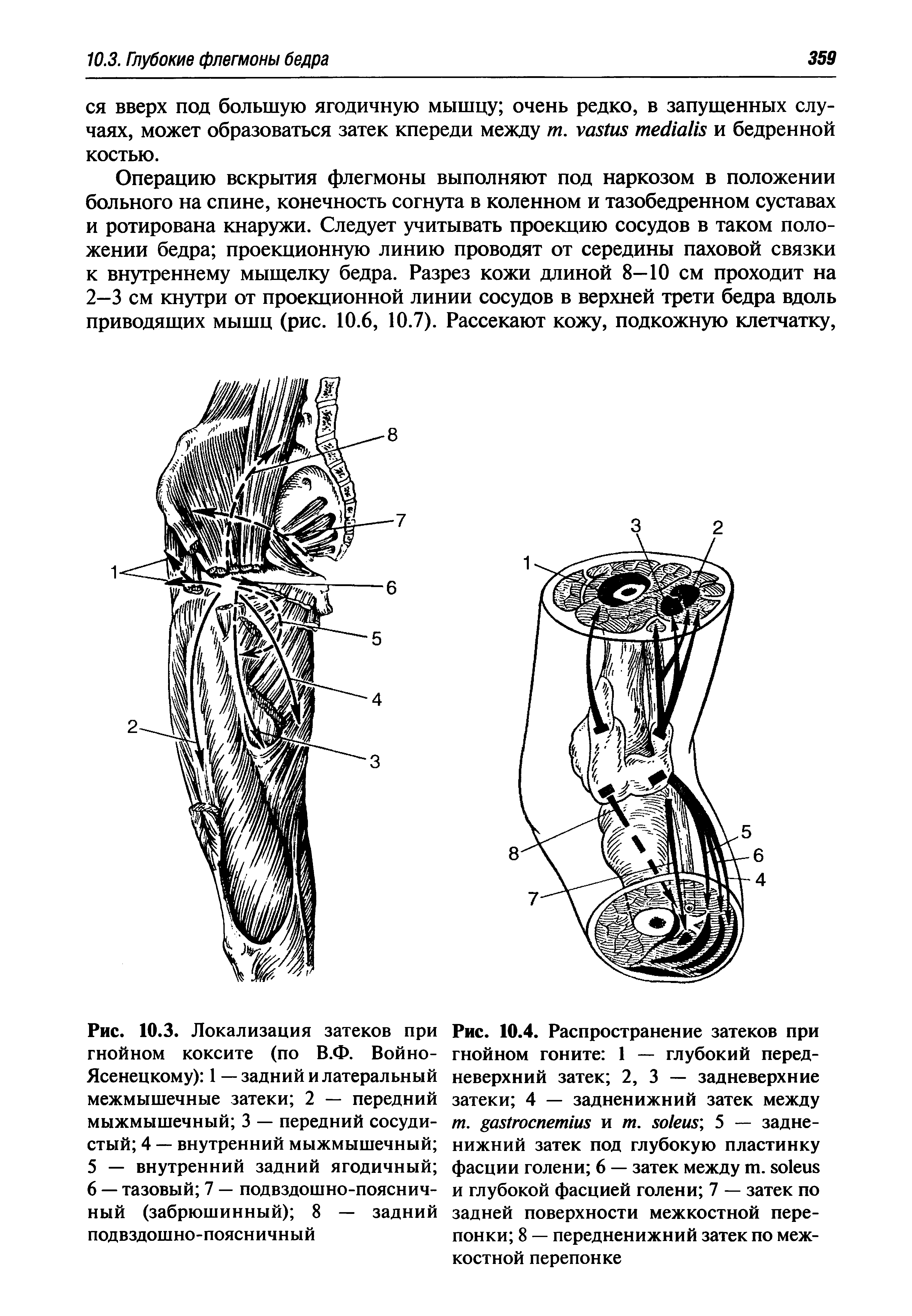 Рис. 10.3. Локализация затеков при гнойном коксите (по В.Ф. Войно-Ясенецкому) 1 — задний и латеральный межмышечные затеки 2 — передний мыжмышечный 3 — передний сосудистый 4 — внутренний мыжмышечный ...