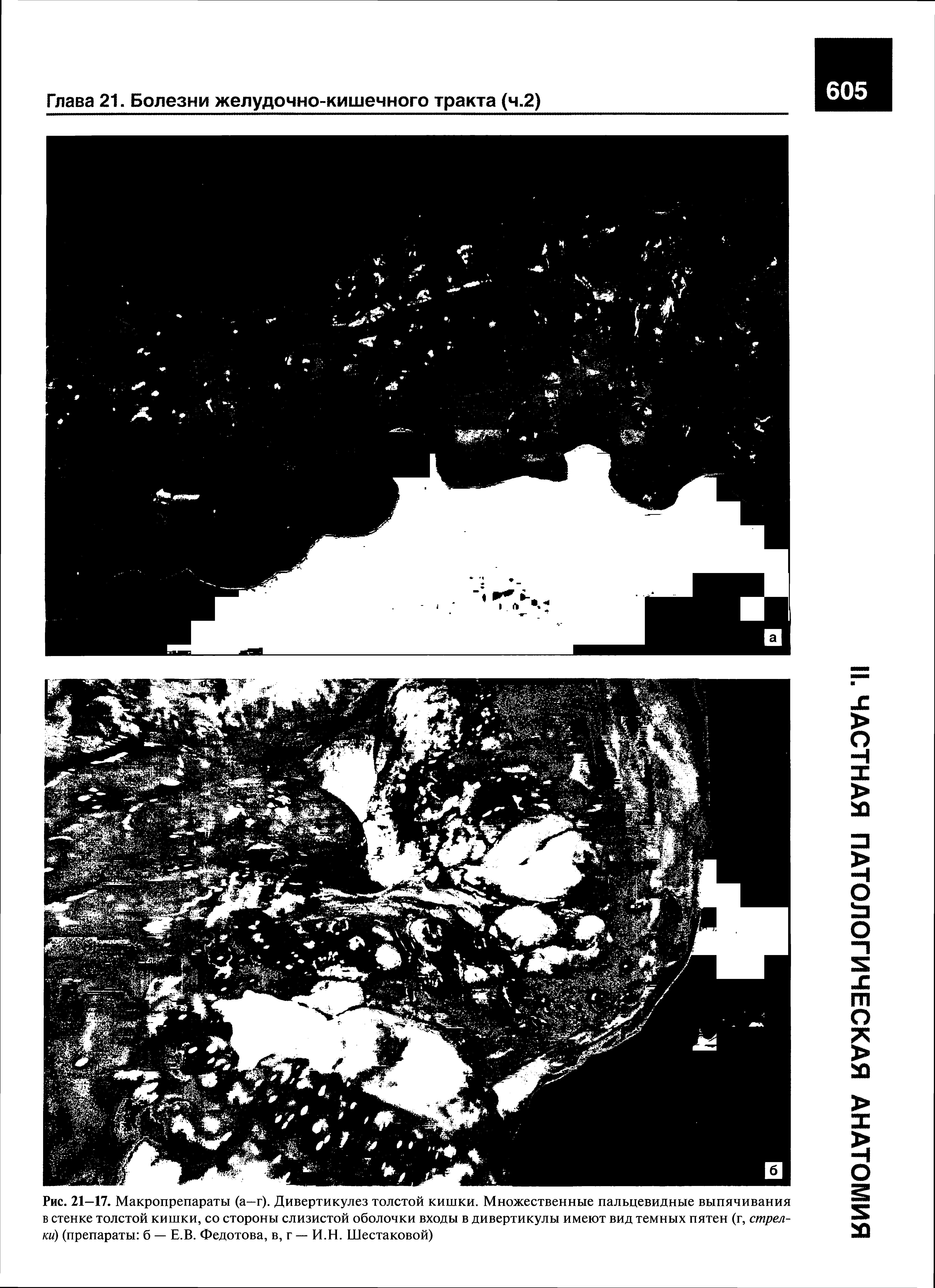 Рис. 21—17. Макропрепараты (а—г). Дивертикулез толстой кишки. Множественные пальцевидные выпячивания в стенке толстой кишки, со стороны слизистой оболочки входы в дивертикулы имеют вид темных пятен (г, стрелки) (препараты б — Е.В. Федотова, в, г — И.Н. Шестаковой)...