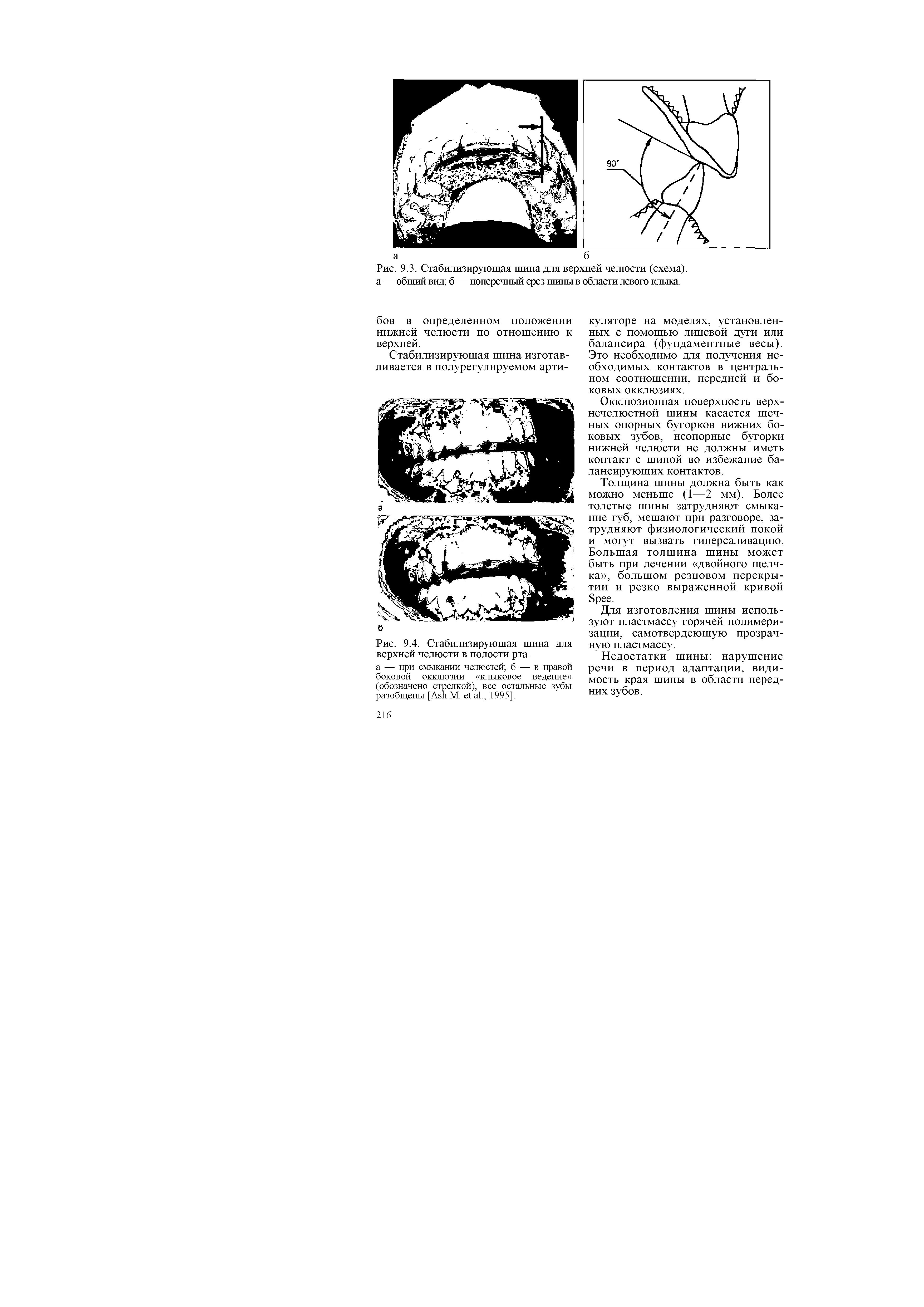 Рис. 9.3. Стабилизирующая шина для верхней челюсти (схема), а — общий вид б — поперечный срез шины в области левого клыка.