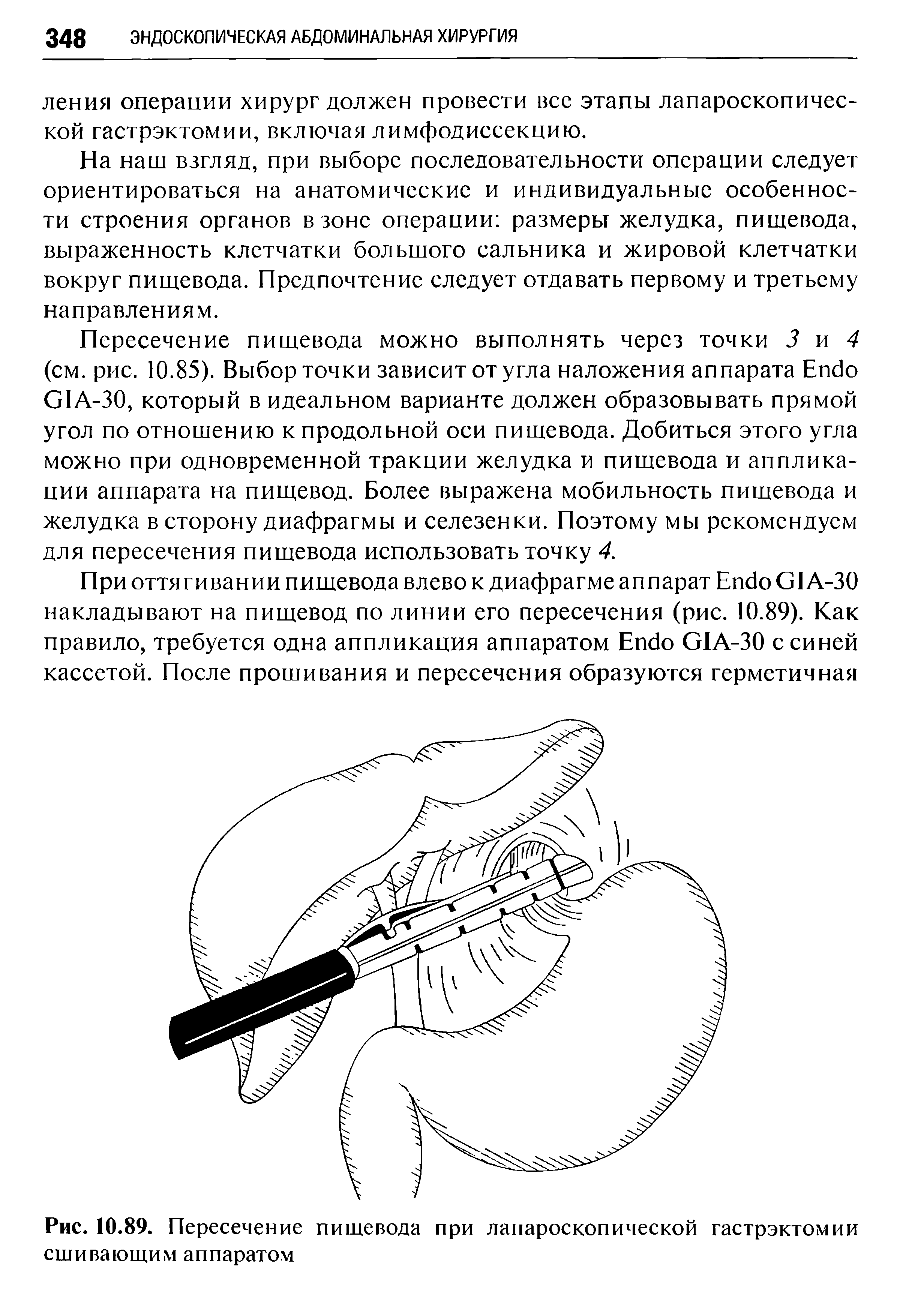 Рис. 10.89. Пересечение пищевода при лапароскопической гастрэктомии сшивающим аппаратом...