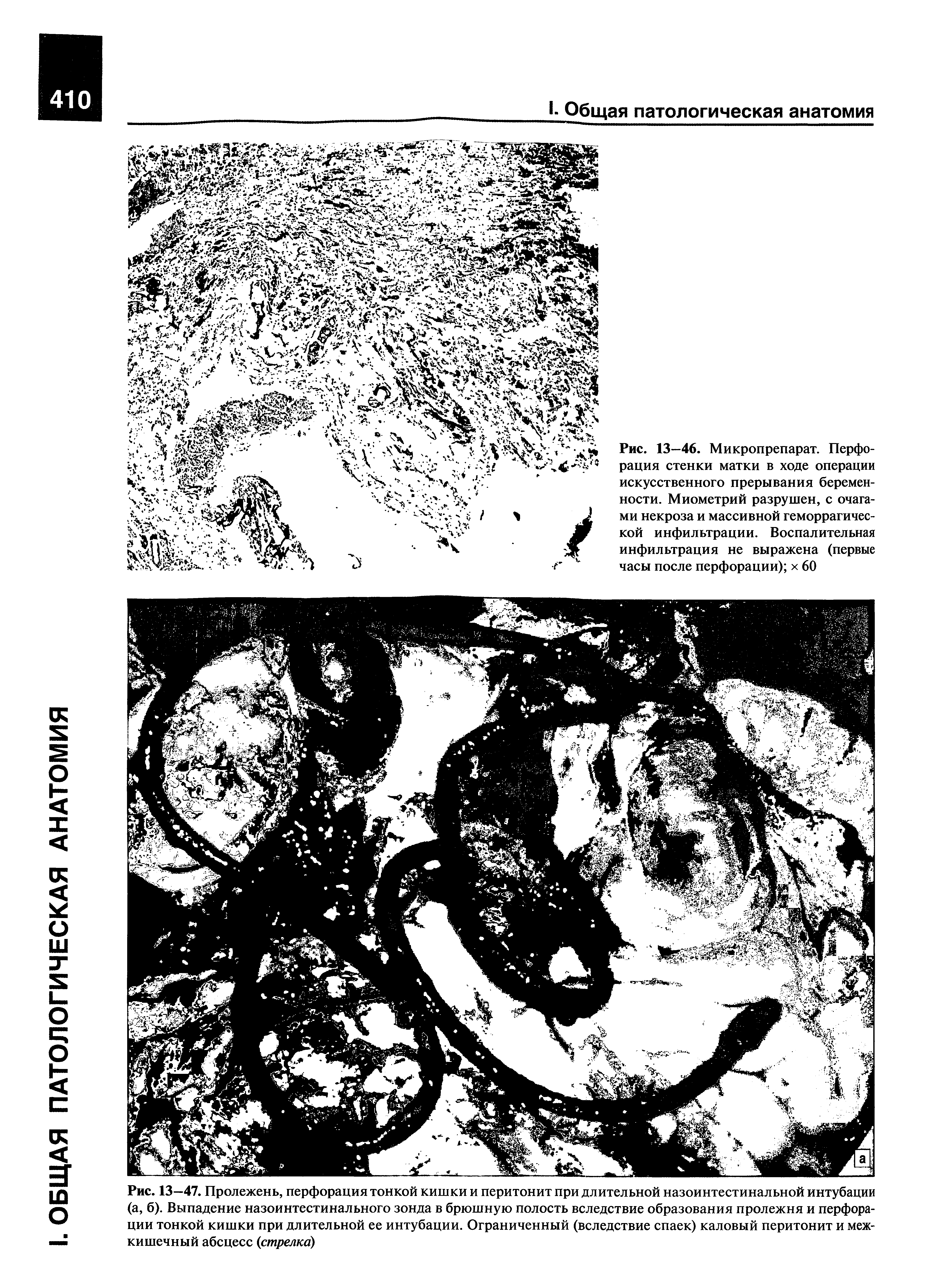 Рис. 13-47. Пролежень, перфорация тонкой кишки и перитонит при длительной назоинтестинальной интубации (а, б). Выпадение назоинтестинального зонда в брюшную полость вследствие образования пролежня и перфорации тонкой кишки при длительной ее интубации. Ограниченный (вследствие спаек) каловый перитонит и межкишечный абсцесс (стрелке ...