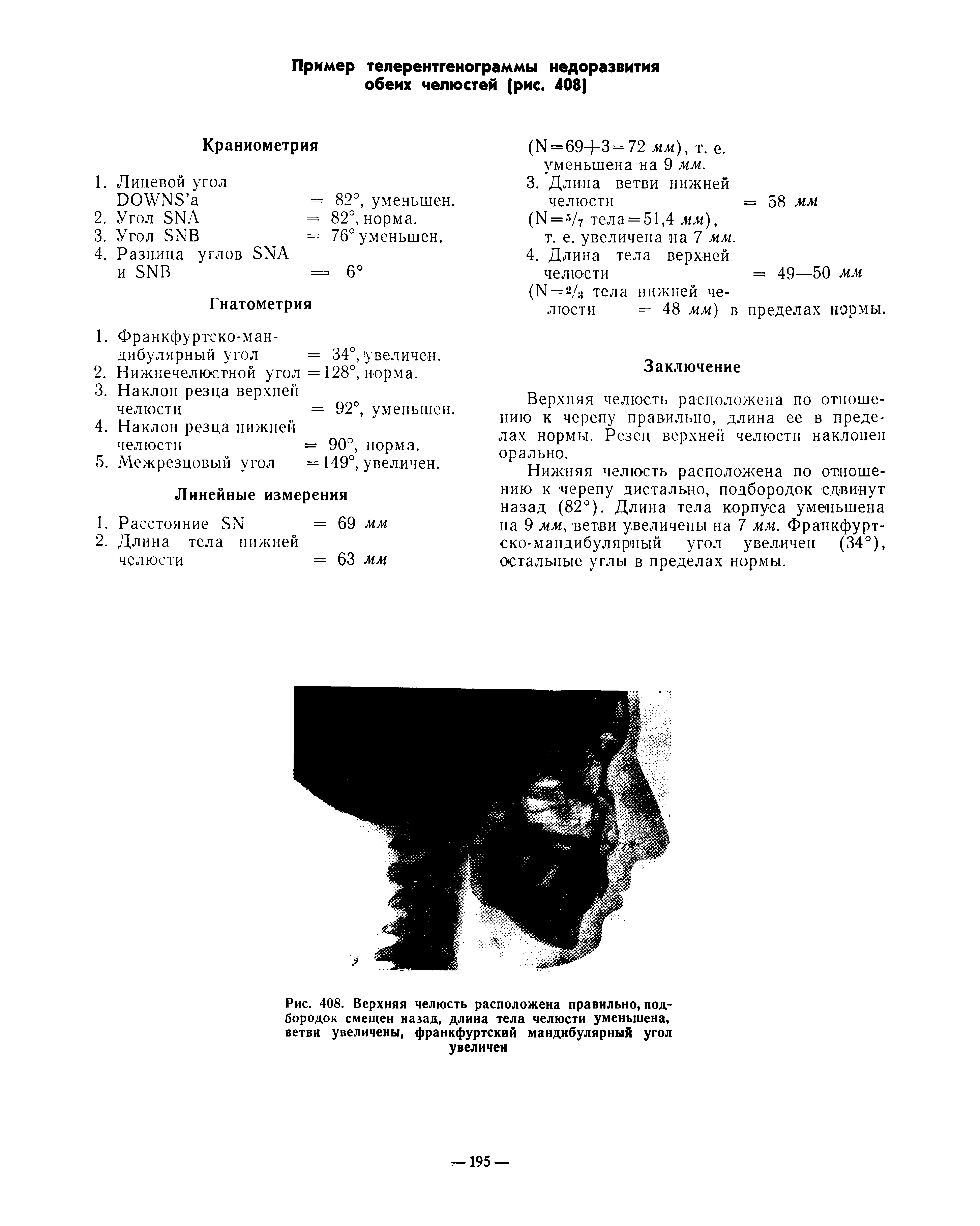 Рис. 408. Верхняя челюсть расположена правильно, подбородок смещен назад, длина тела челюсти уменьшена, ветви увеличены, франкфуртский мандибулярный угол увеличен...