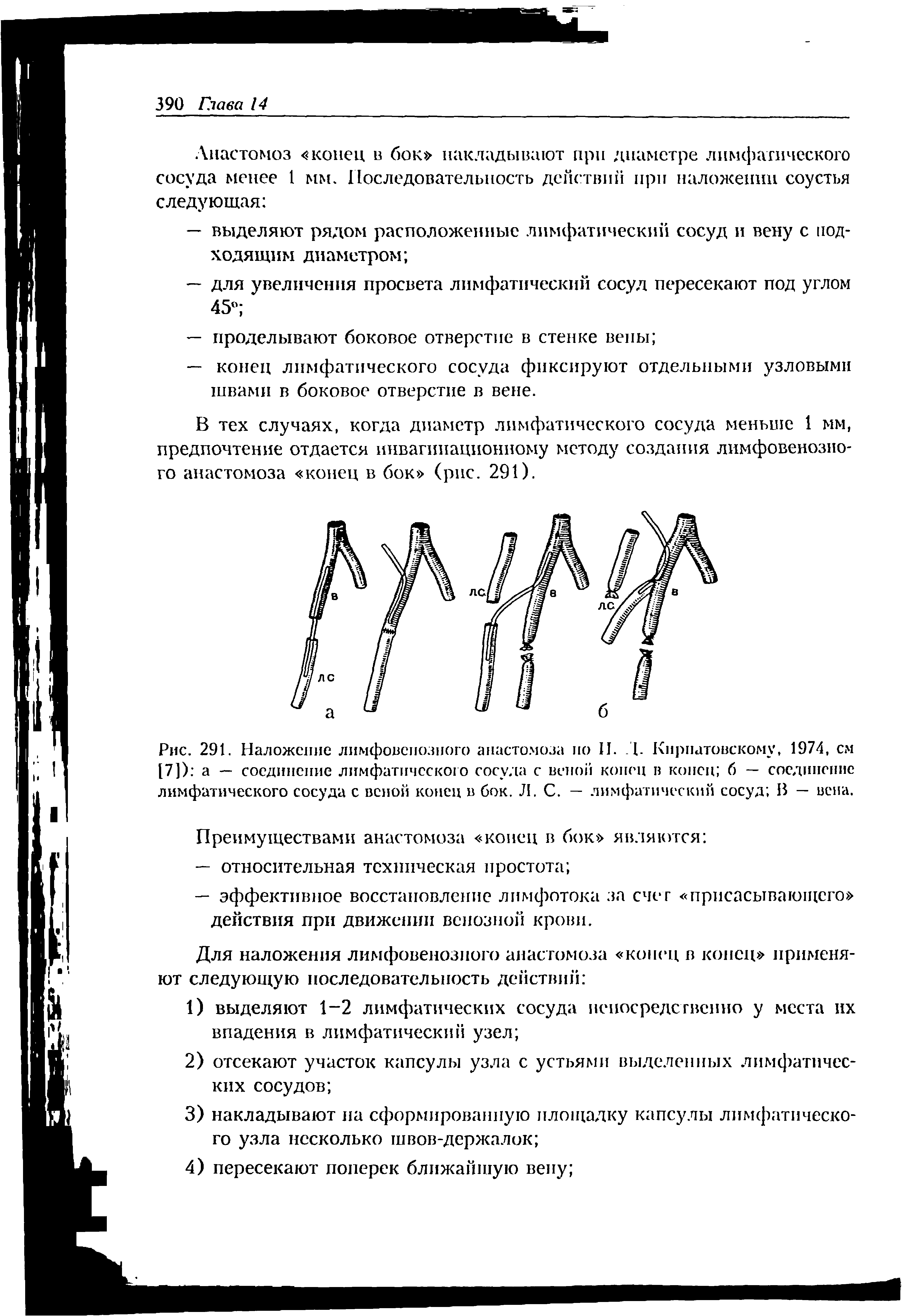 Рис. 291. Наложение лимфовспозного анастомоза но II. Д. Кирпатовскому, 1974, см [7]) а — соединение лимфатического сосуда с веной конец в конец б — соединение лимфатического сосуда с веной конец в бок. Л. С. — лимфатический сосуд В — вена.