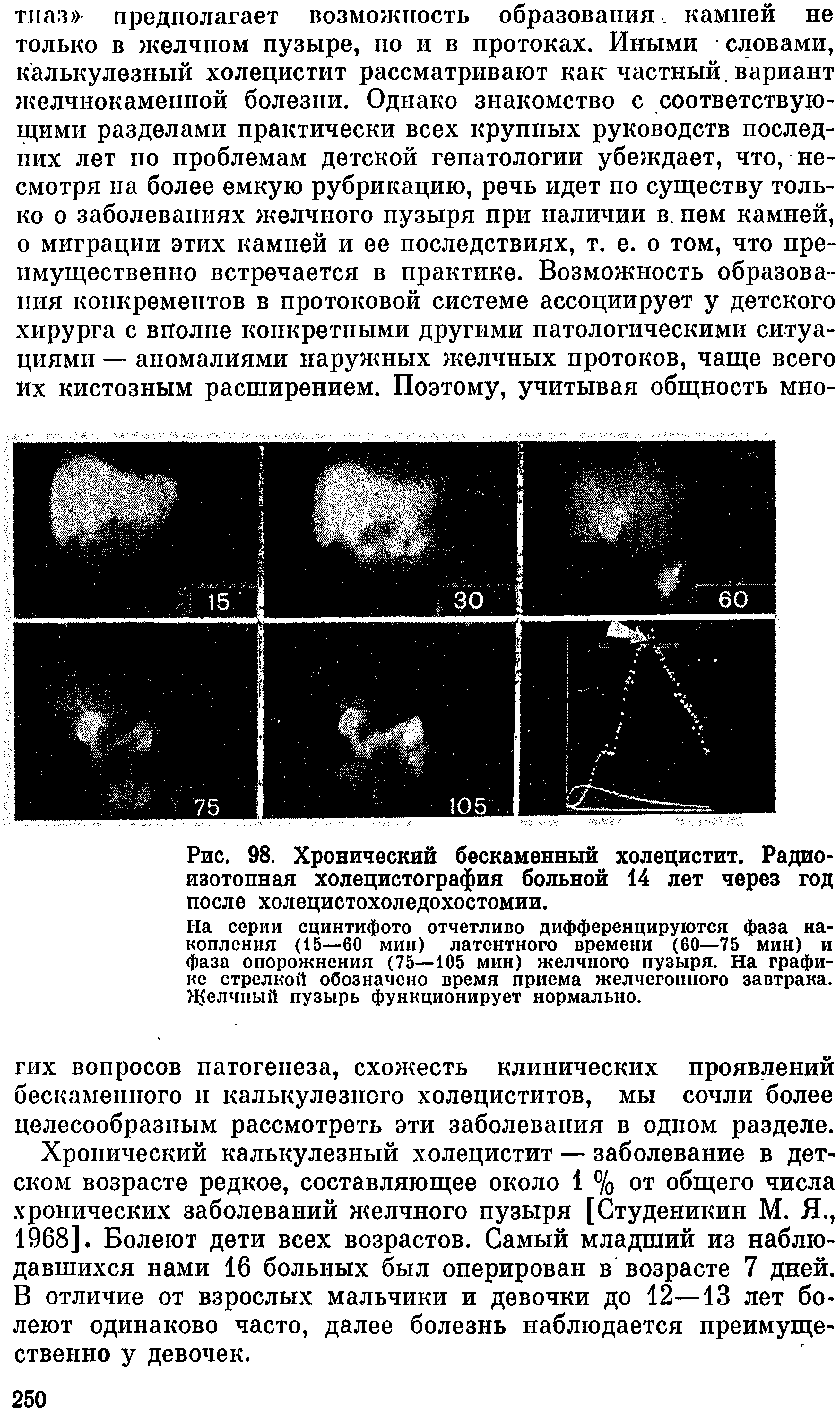 Рис. 98. Хронический бескаменный холецистит. Радиоизотопная холецистография больной 14 лет через год после холецистохоледохостомии.