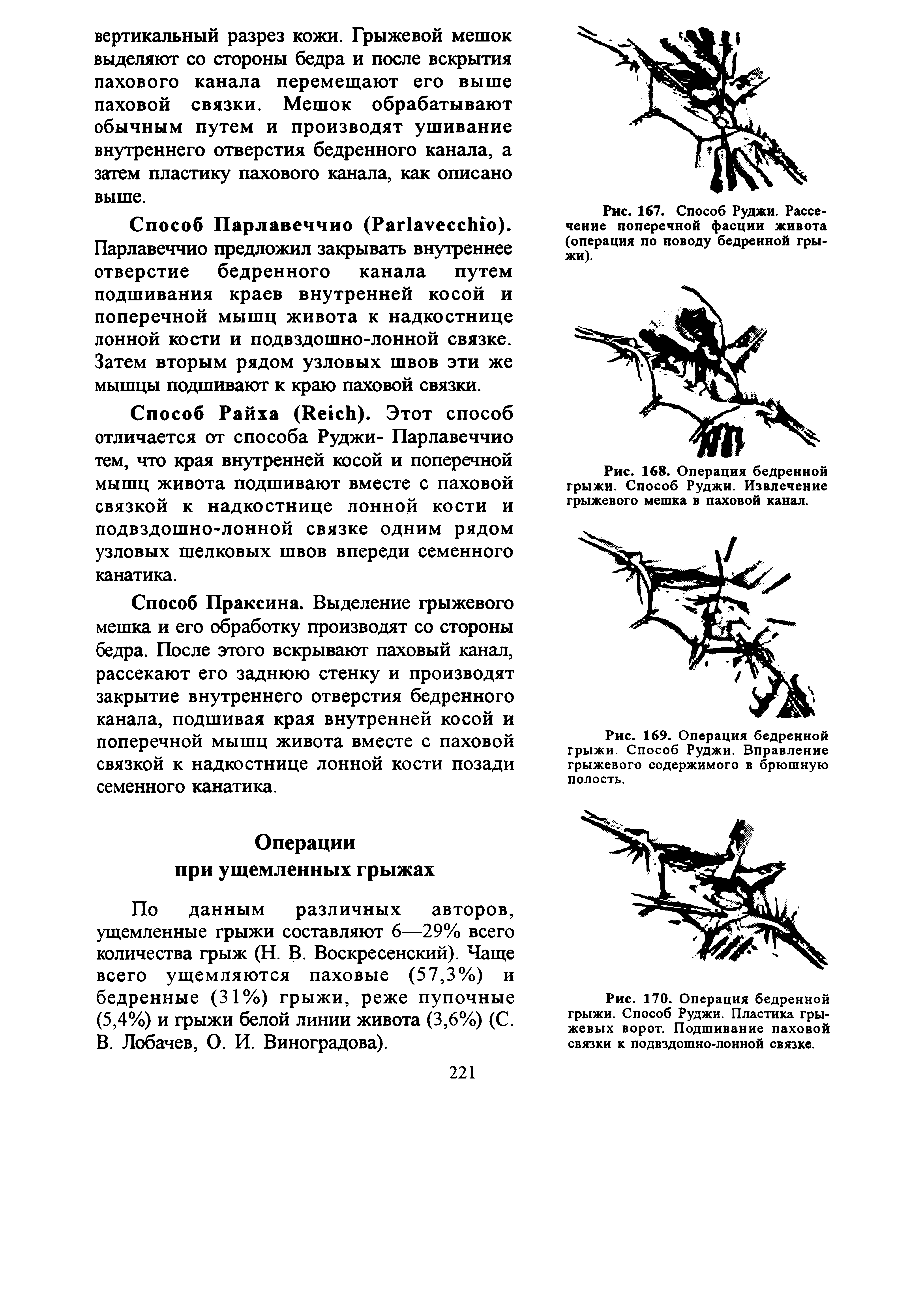 Рис. 167. Способ Руджи. Рассечение поперечной фасции живота (операция по поводу бедренной гры-...