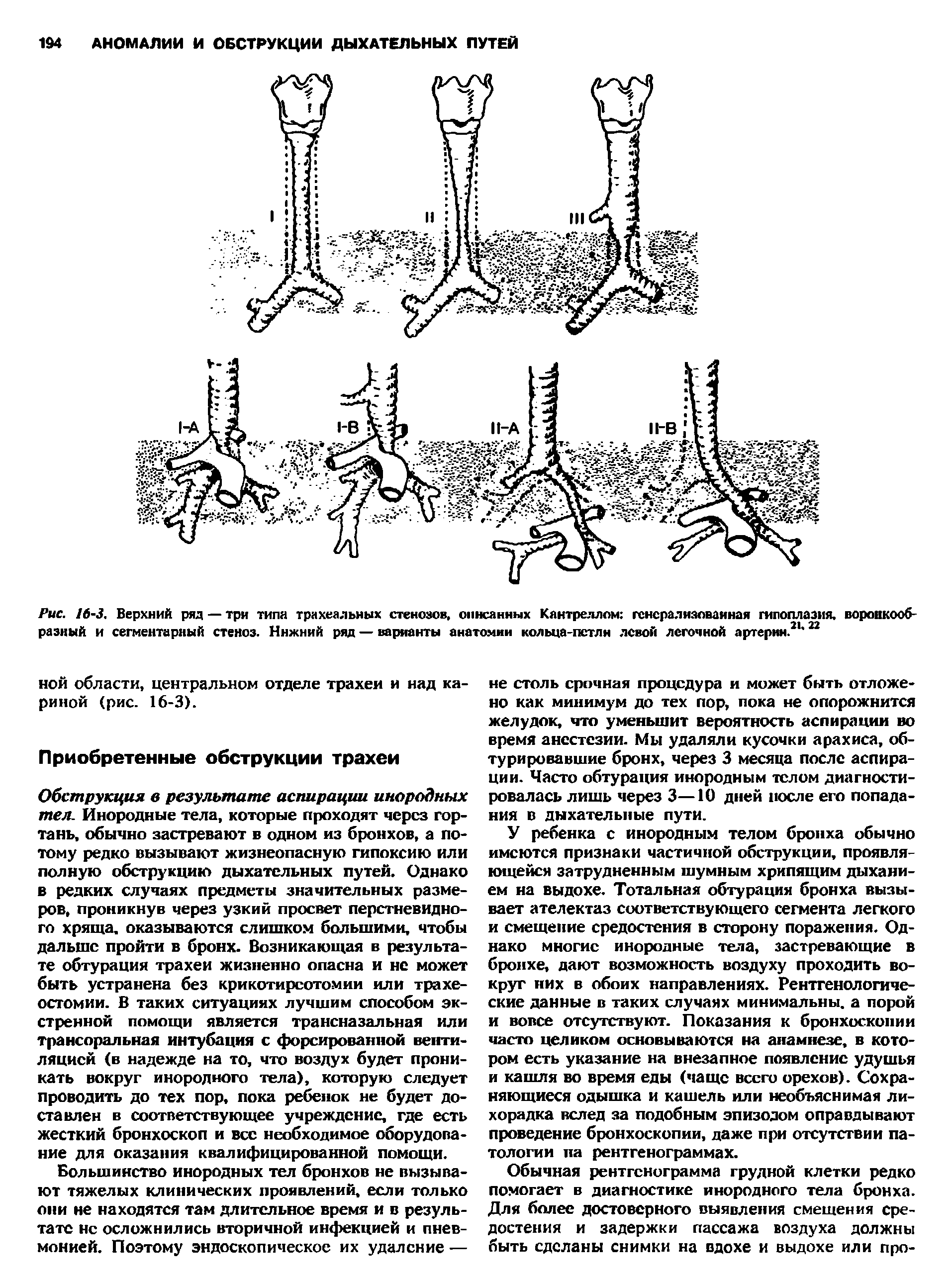 Рис. 16-3. Верхний ряд — три типа трахеальных стенозов, описанных Кантреллом генерализованная гипоплазия, воронкообразный и сегментарный стеноз. Ннжний ряд — варианты анатомии кольца-петли левой легочной артерии.21,22...