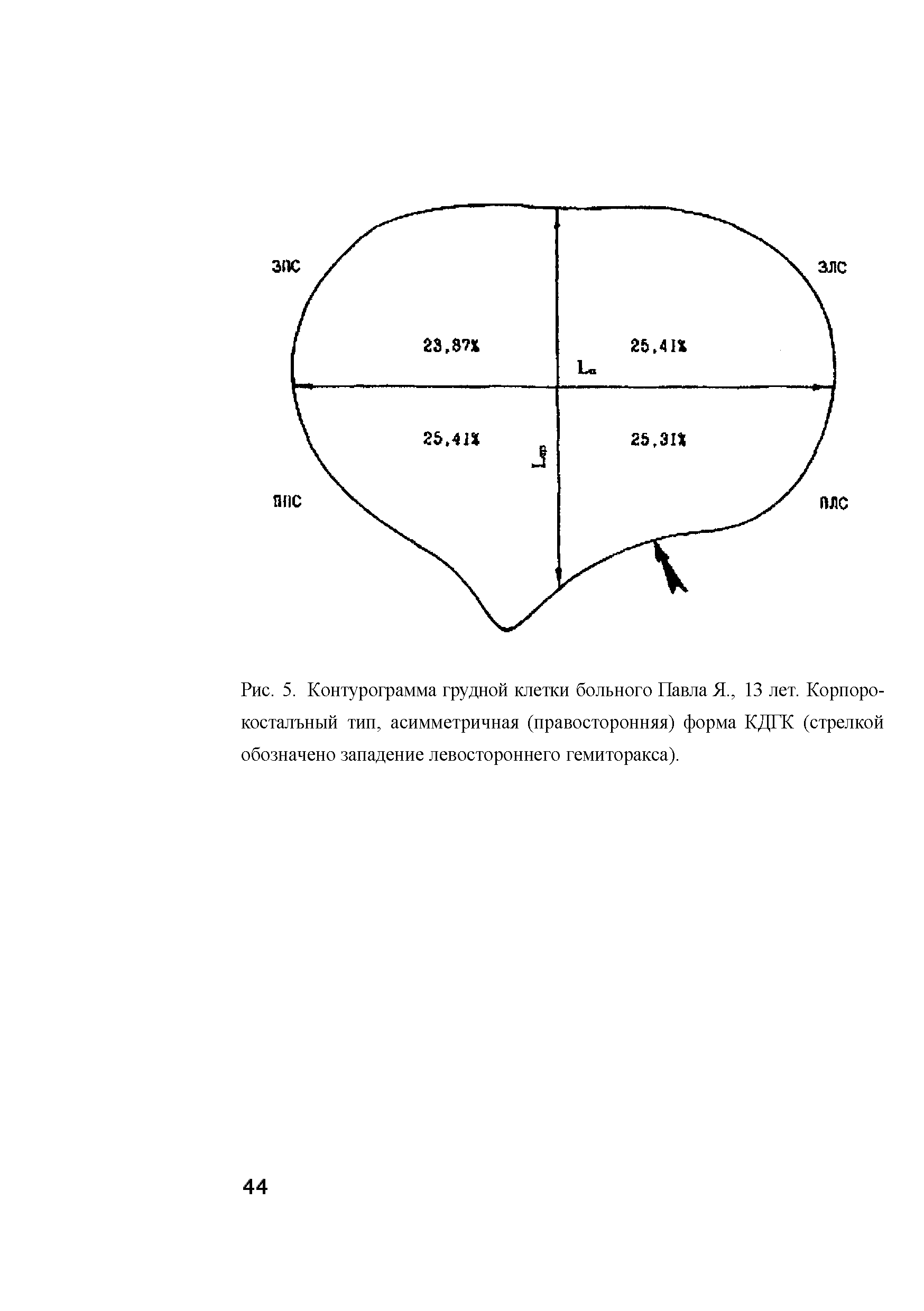 Рис. 5. Контурограмма грудной клетки больного Павла Я., 13 лет. Корпоро-косталъный тип, асимметричная (правосторонняя) форма КДГК (стрелкой обозначено западение левостороннего гемиторакса).