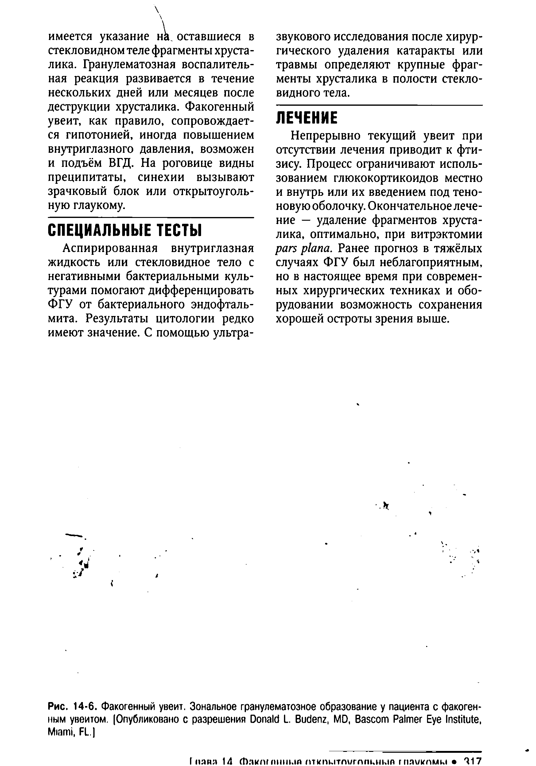 Рис. 14-6. Факогенный увеит. Зональное гранулематозное образование у пациента с факогенным увеитом. (Опубликовано с разрешения D L. B , MD, B P E I , M , FL ]...