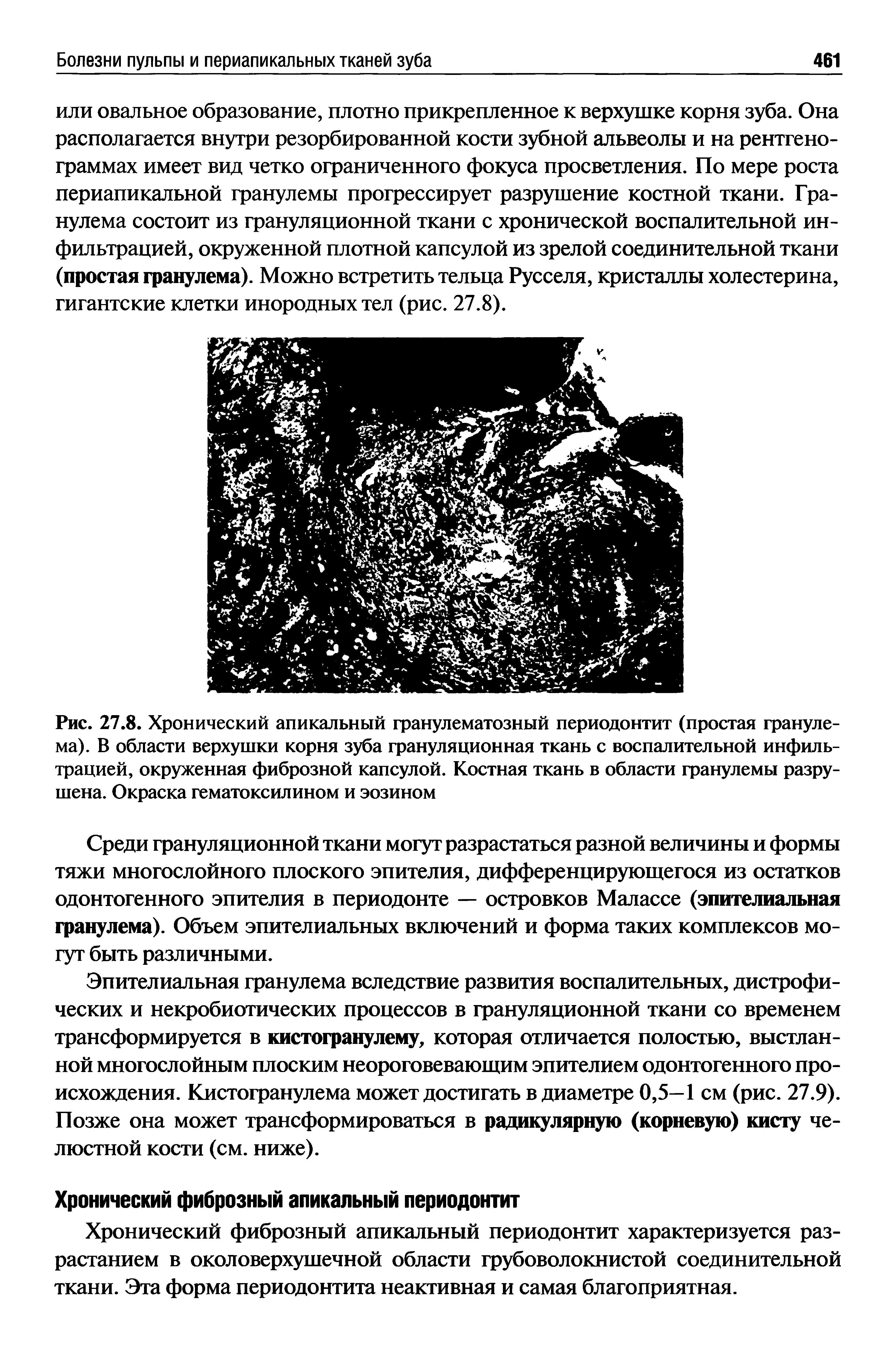 Рис. 27.8. Хронический апикальный гранулематозный периодонтит (простая гранулема). В области верхушки корня зуба грануляционная ткань с воспалительной инфильтрацией, окруженная фиброзной капсулой. Костная ткань в области гранулемы разрушена. Окраска гематоксилином и эозином...