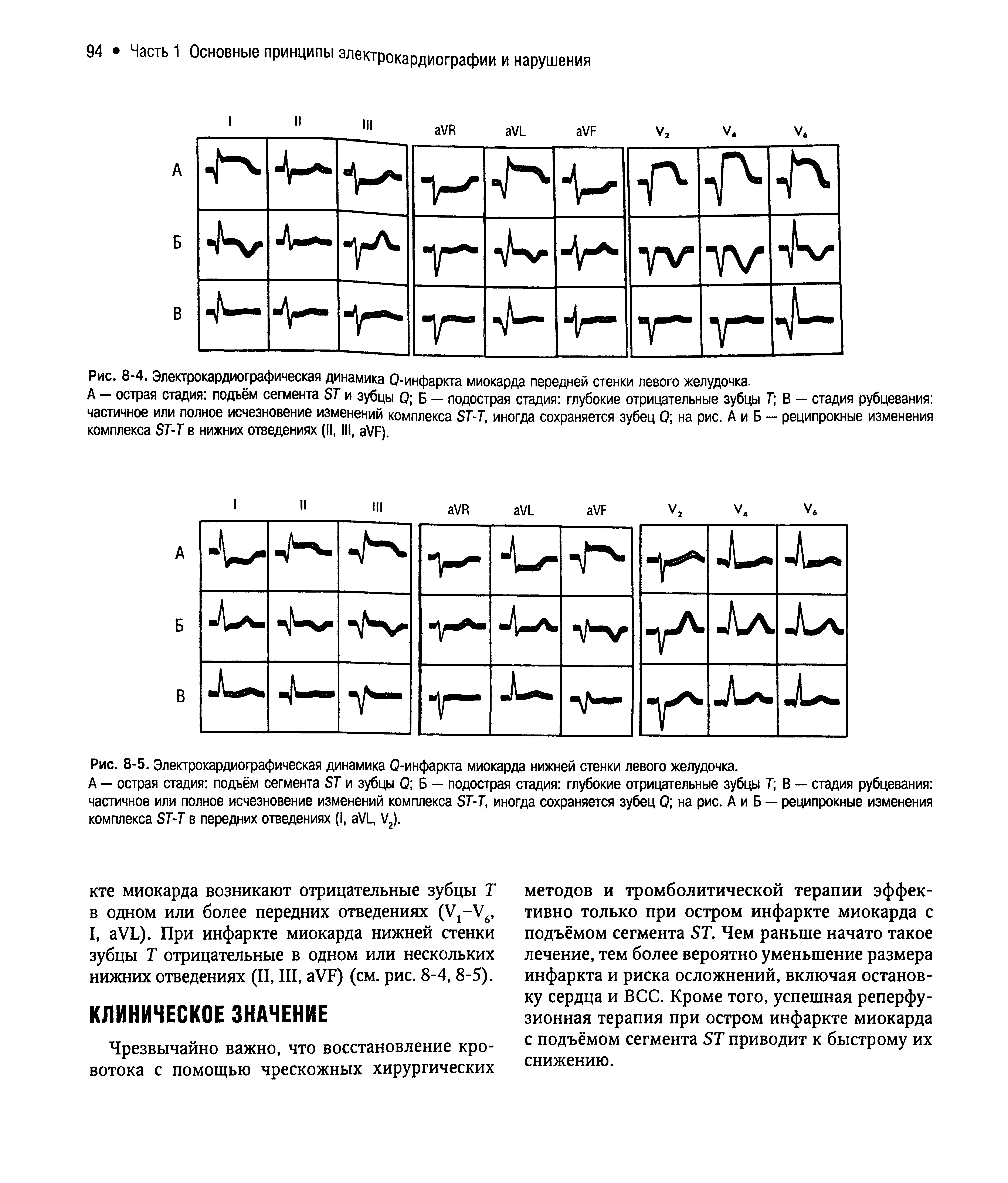 Рис. 8-4. Электрокардиографическая динамика Q-инфаркта миокарда передней стенки левого желудочка.