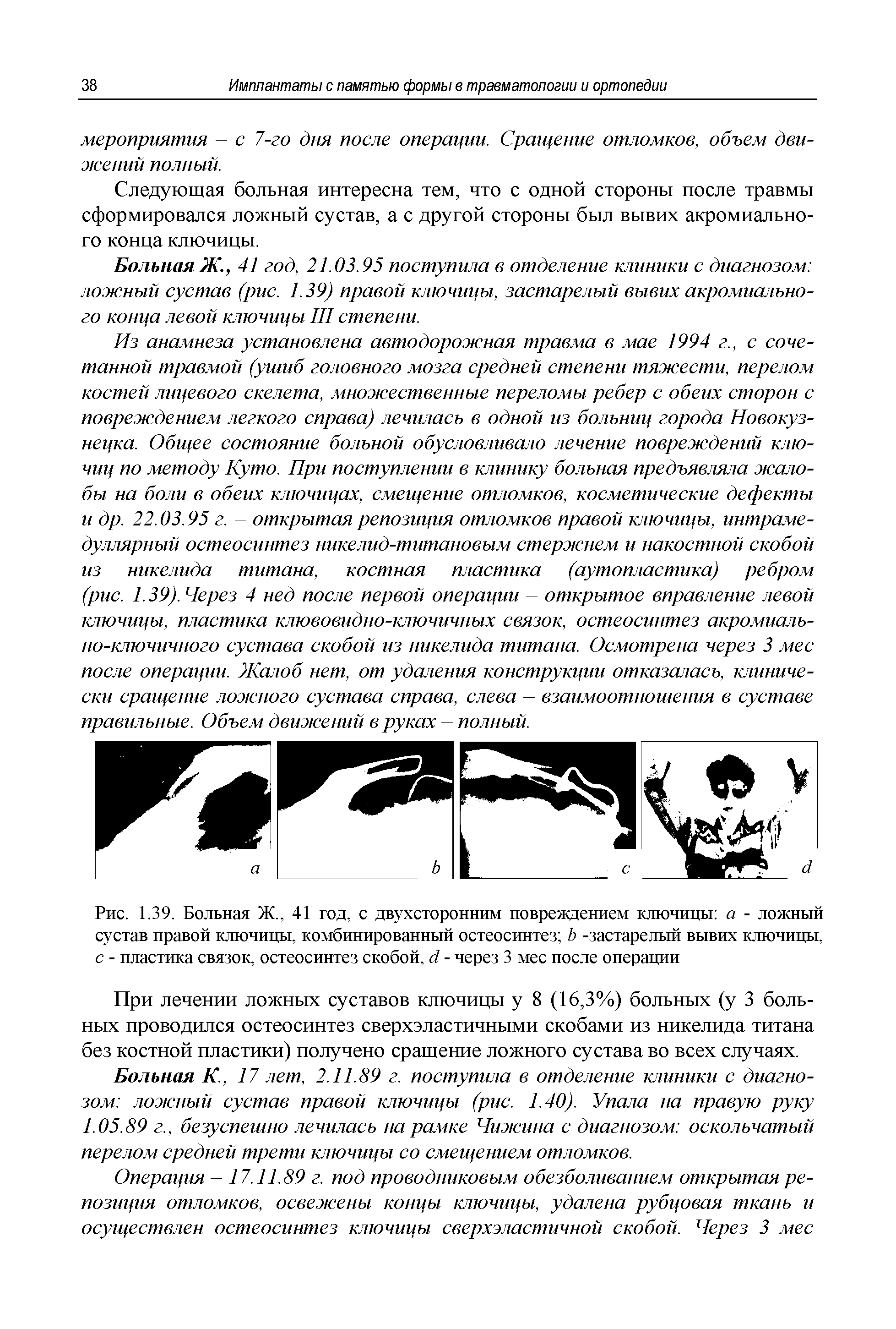 Рис. 1.39. Больная Ж., 41 год, с двухсторонним повреждением ключицы а - ложный сустав правой ключицы, комбинированный остеосинтез Ь -застарелый вывих ключицы, с - пластика связок, остеосинтез скобой, с - через 3 мес после операции...