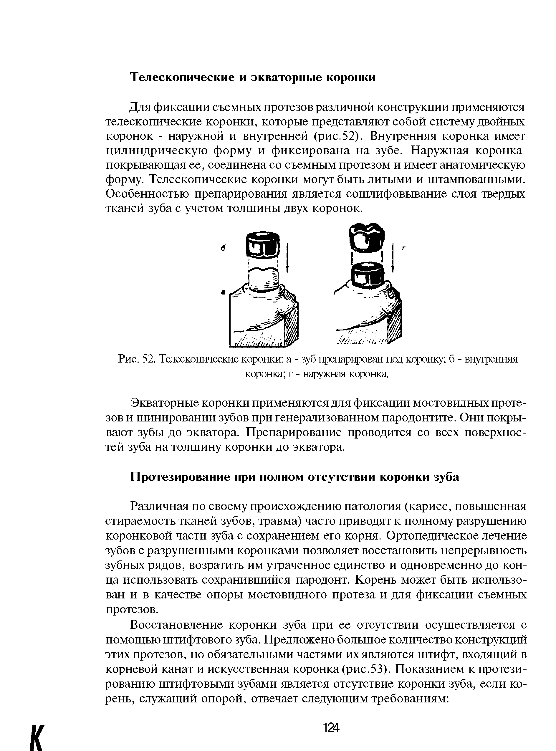 Рис. 52. Телескопические коронки а - зуб препарирован под коронку б - внутренняя коронка г - наружная коронка...