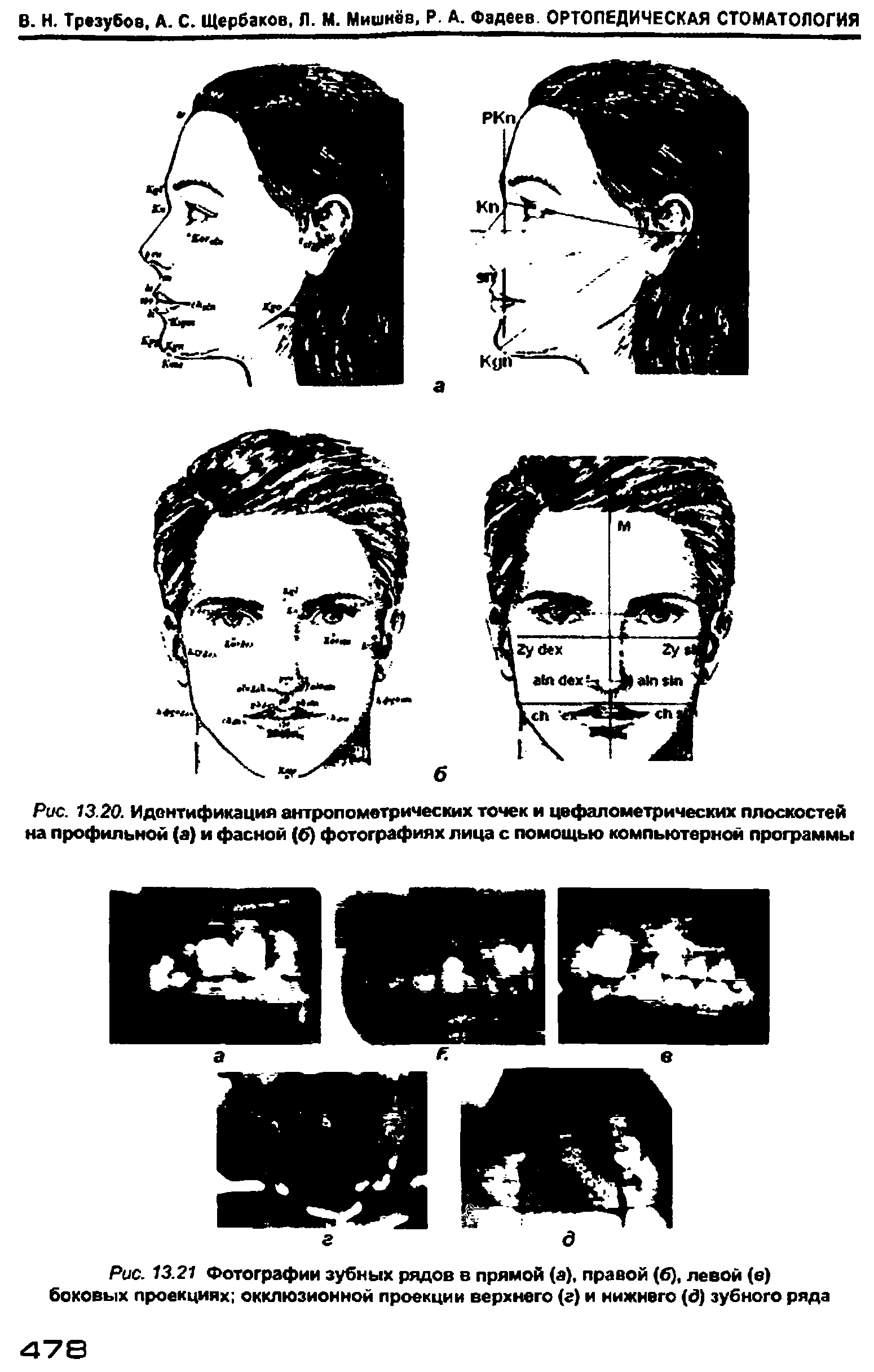 Рис. 13.20. Идентификация антропометрических точек и цефалометрических плоскостей на профильной (а) и фасной (б) фотографиях лица с помощью компьютерном программы...
