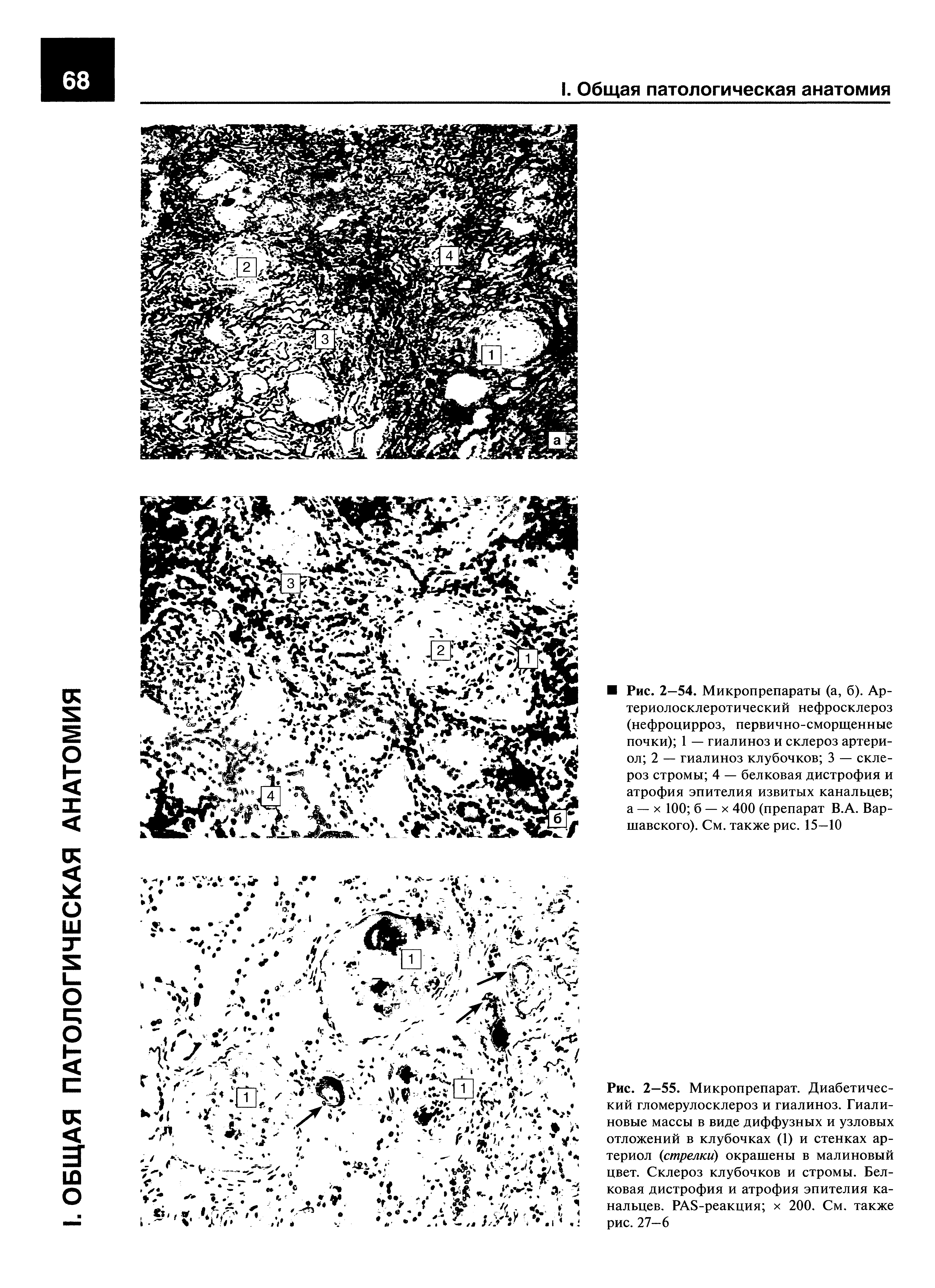 Рис. 2—55. Микропрепарат. Диабетический гломерулосклероз и гиалиноз. Гиалиновые массы в виде диффузных и узловых отложений в клубочках (1) и стенках артериол (стрелки) окрашены в малиновый цвет. Склероз клубочков и стромы. Белковая дистрофия и атрофия эпителия канальцев. PAS-реакция х 200. См. также рис. 27—6...