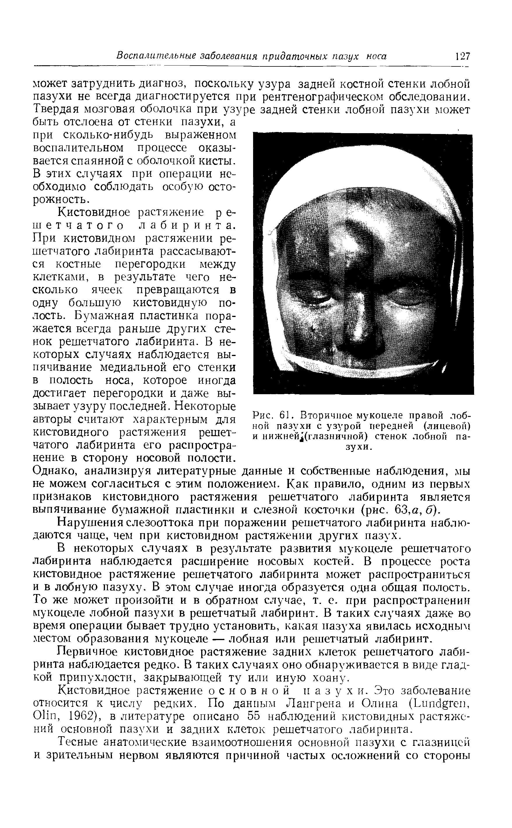 Рис. 61. Вторичное мукоцеле правой лобной пазухи с узурой передней (лицевой) и нижней (глазничной) стенок лобной пазухи.