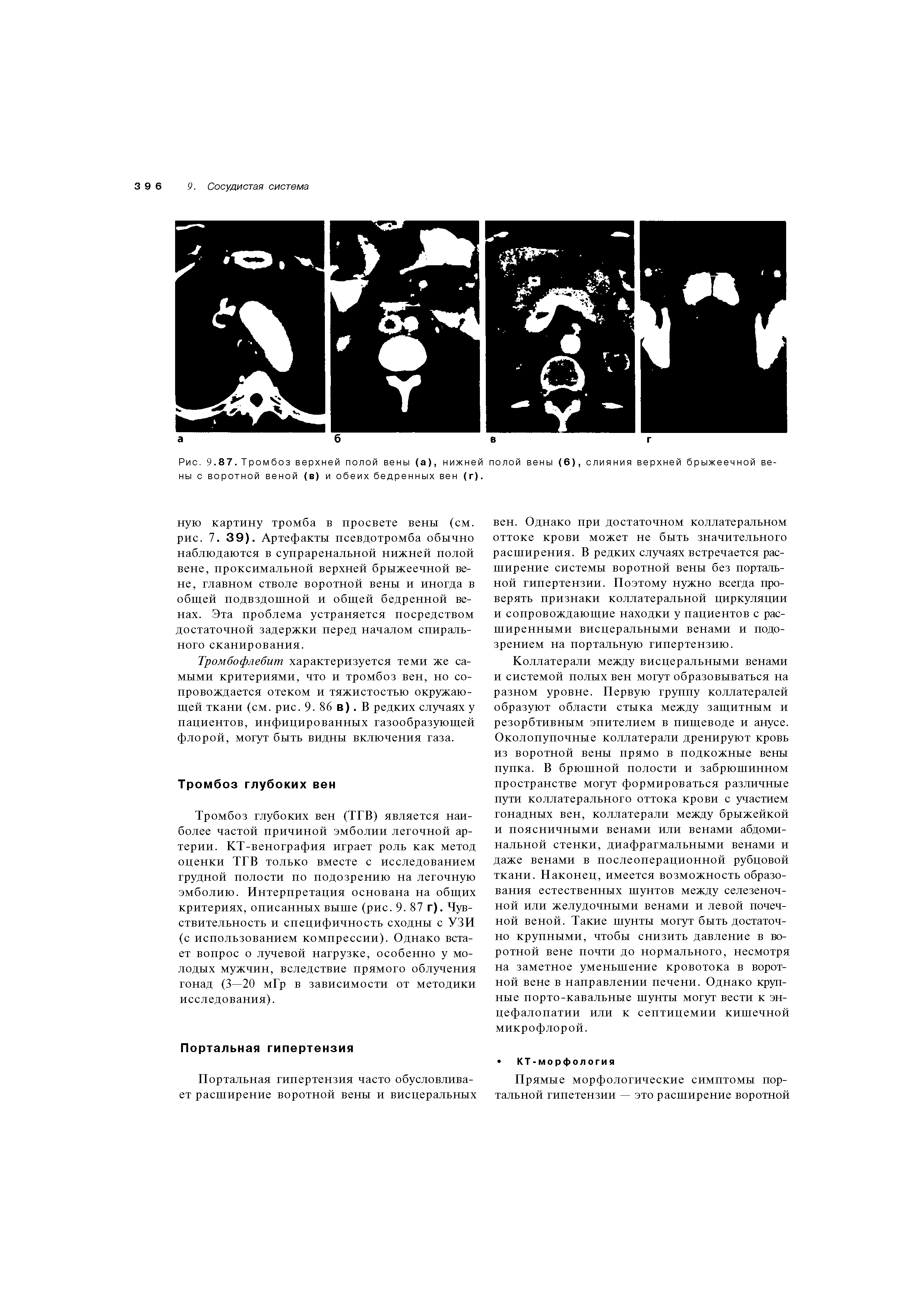 Рис. 9.87. Тромбоз верхней полой вены (а), нижней полой вены (6), слияния верхней брыжеечной ве-...
