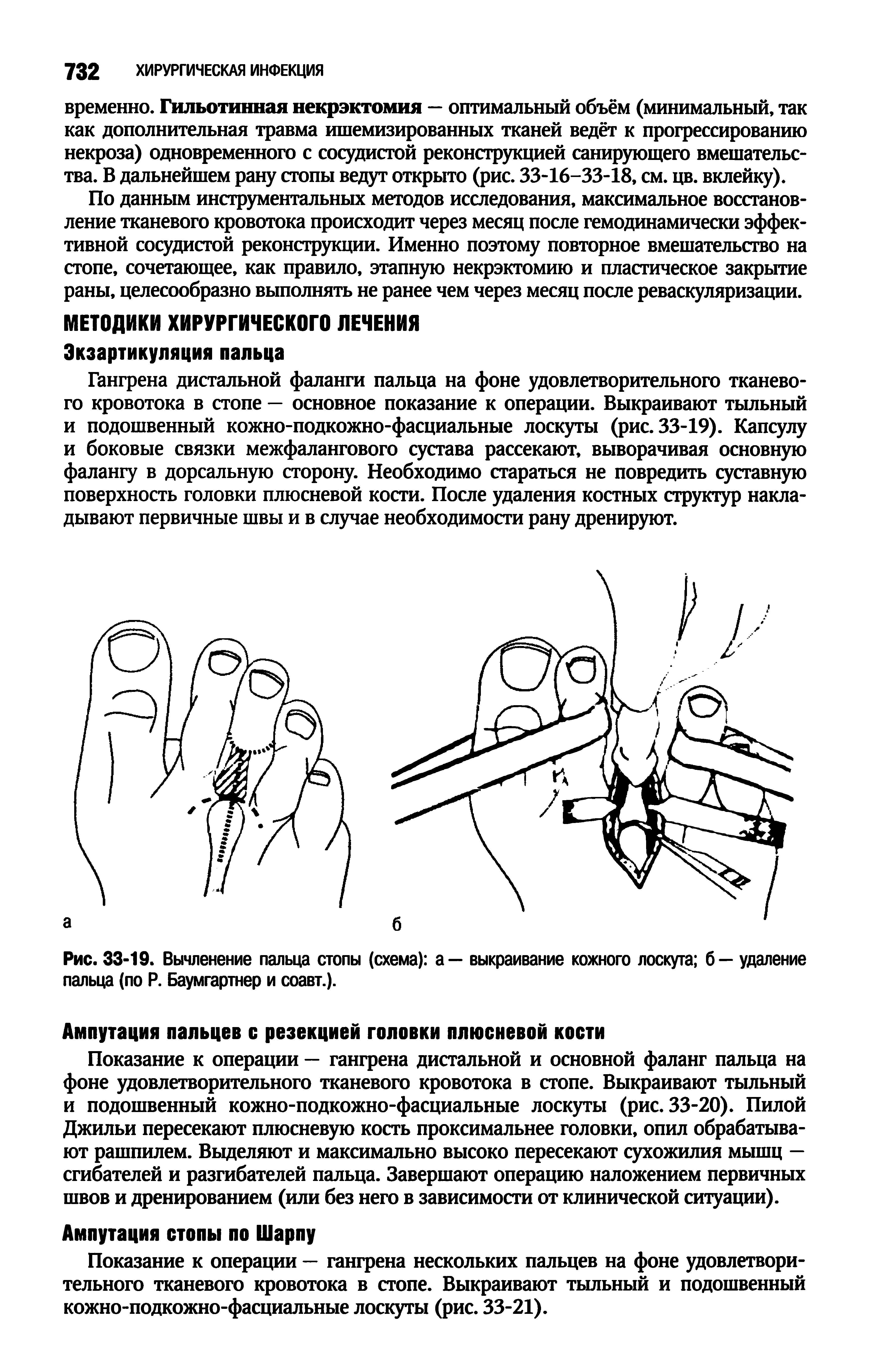 Рис. 33-19. Вычленение пальца стопы (схема) а — выкраивание кожного лоскута б — удаление пальца (по Р. Баумгартнер и соавт.).