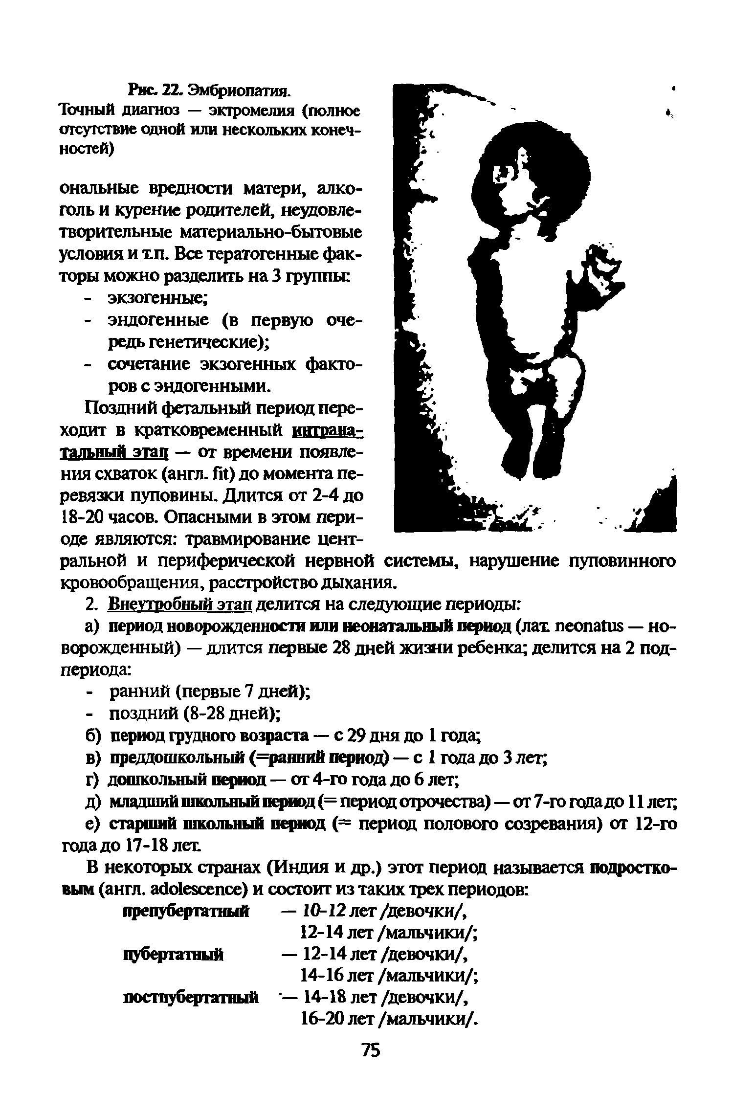 Рис. 22. Эмбриопатия. Точный диагноз — эктромелия (полное отсутствие одной или нескольких конечностей) ональные вредности матери, алкоголь и курение родителей, неудовлетворительные материально-бытовые условия и тп. Все тератогенные факторы можно разделить на 3 группы ...