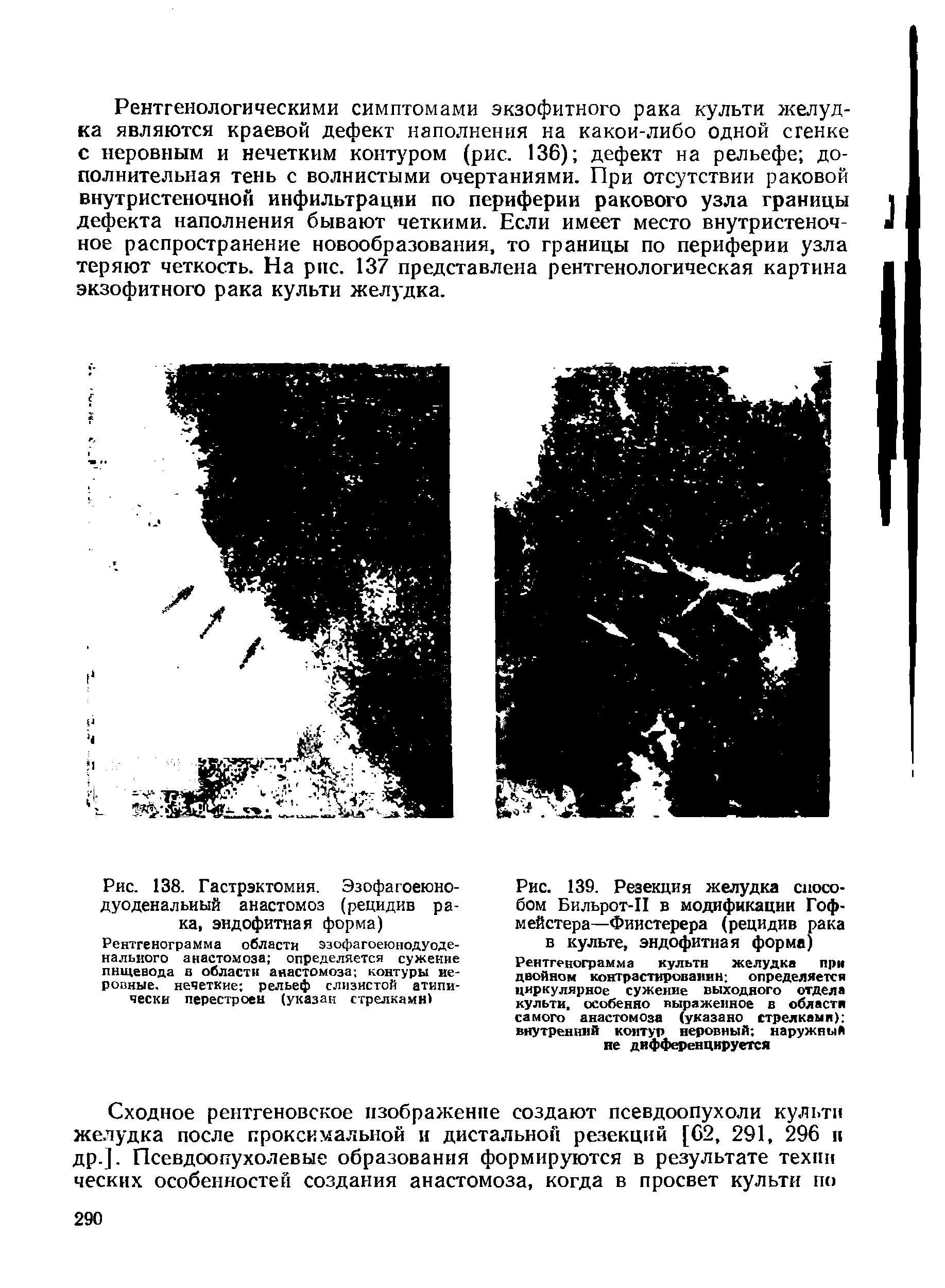 Рис. 138. Гастрэктомия. Эзофагоеюно-дуоденальиый анастомоз (рецидив рака, эндофитная форма)...