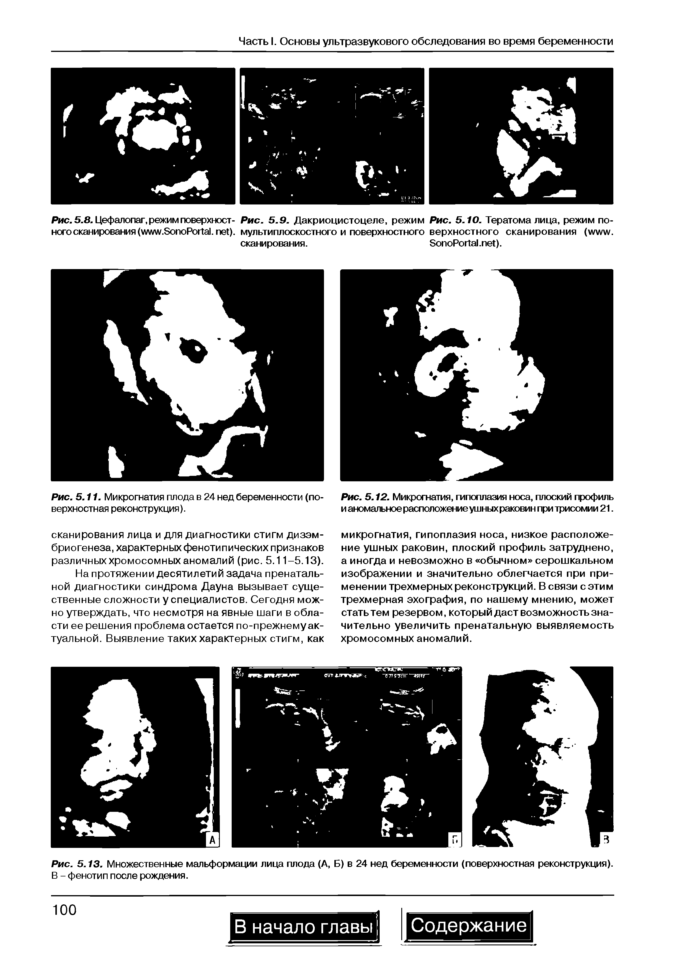 Рис. 5.8. Цефалопаг,режимповерхност- Рис. 5.9. Дакриоцистоцеле, режим Рис. 5.10. Тератома лица, режим по-ного сканирования ( . S P , ), мультиплоскостного и поверхностного верхностного сканирования ( . сканирования. S P . ).