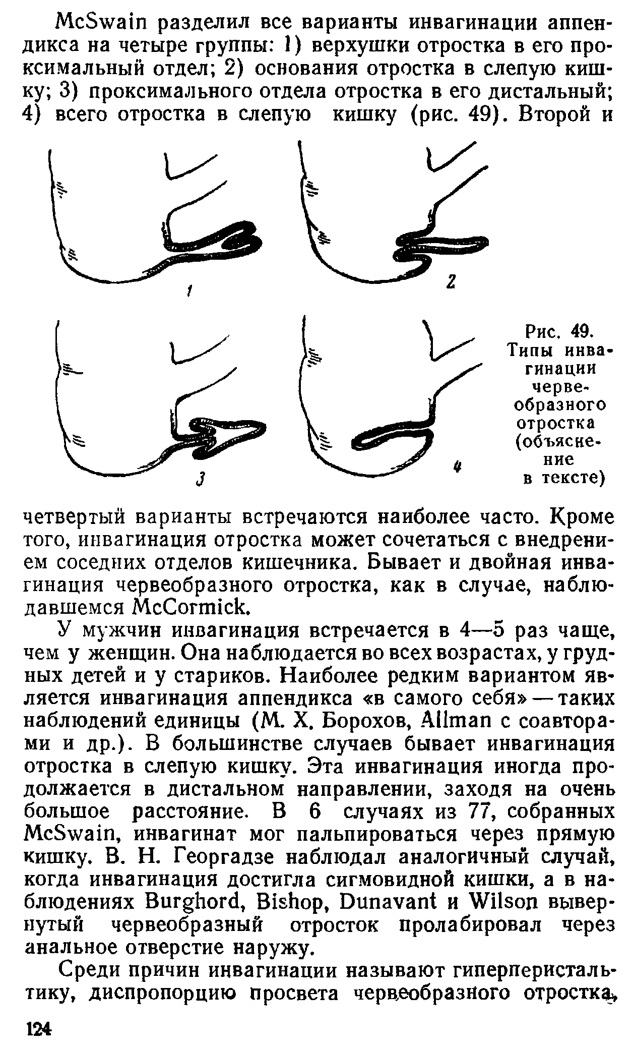 Рис. 49. Типы инвагинации червеобразного отростка (объяснение в тексте)...