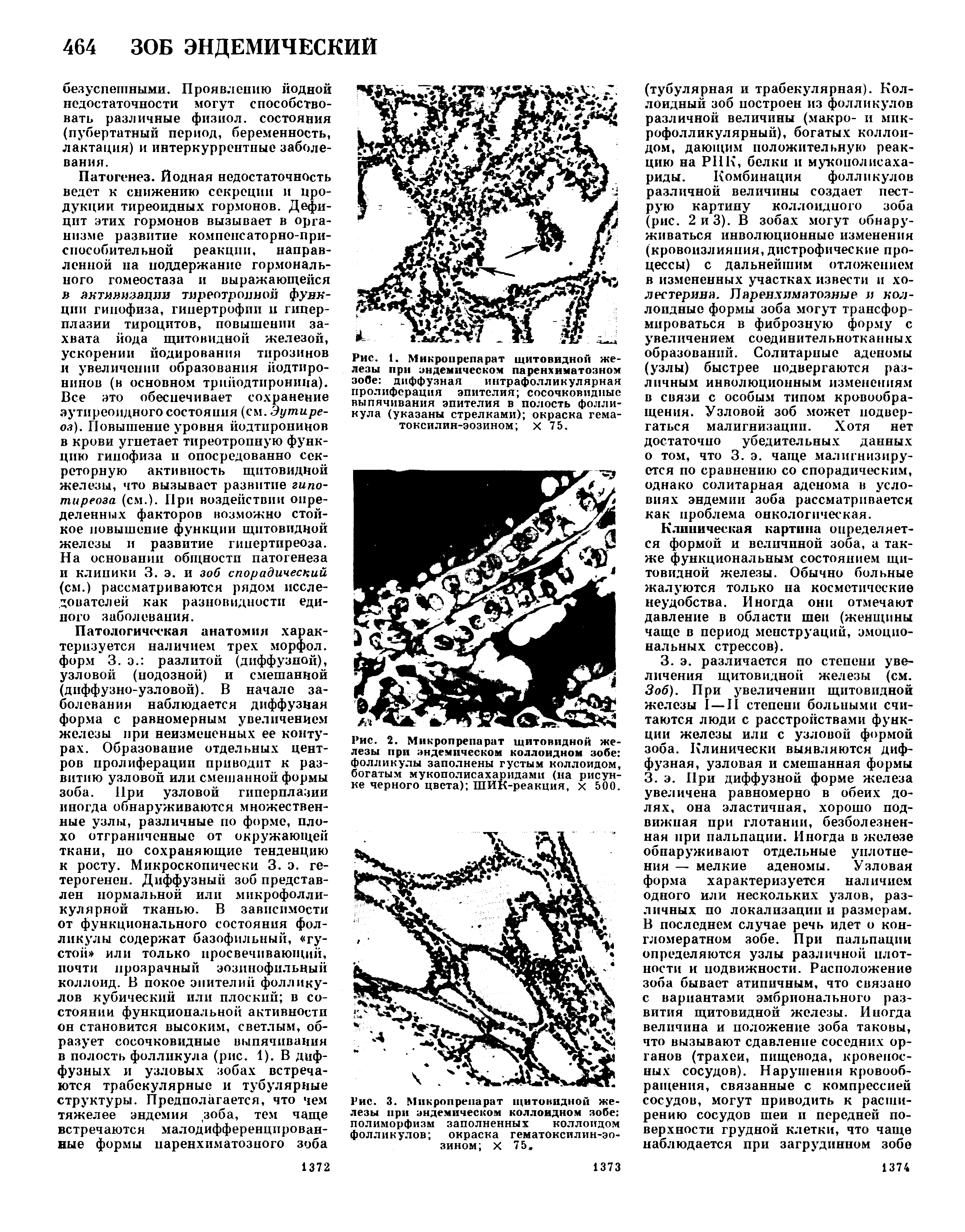 Рис. 2. Микропрепарат щитовидной железы при эндемическом коллоидном зобе фолликулы заполнены густым коллоидом, богатым мукополисахаридами (иа рисунке черного цвета) ШИК-реакция, х 500.