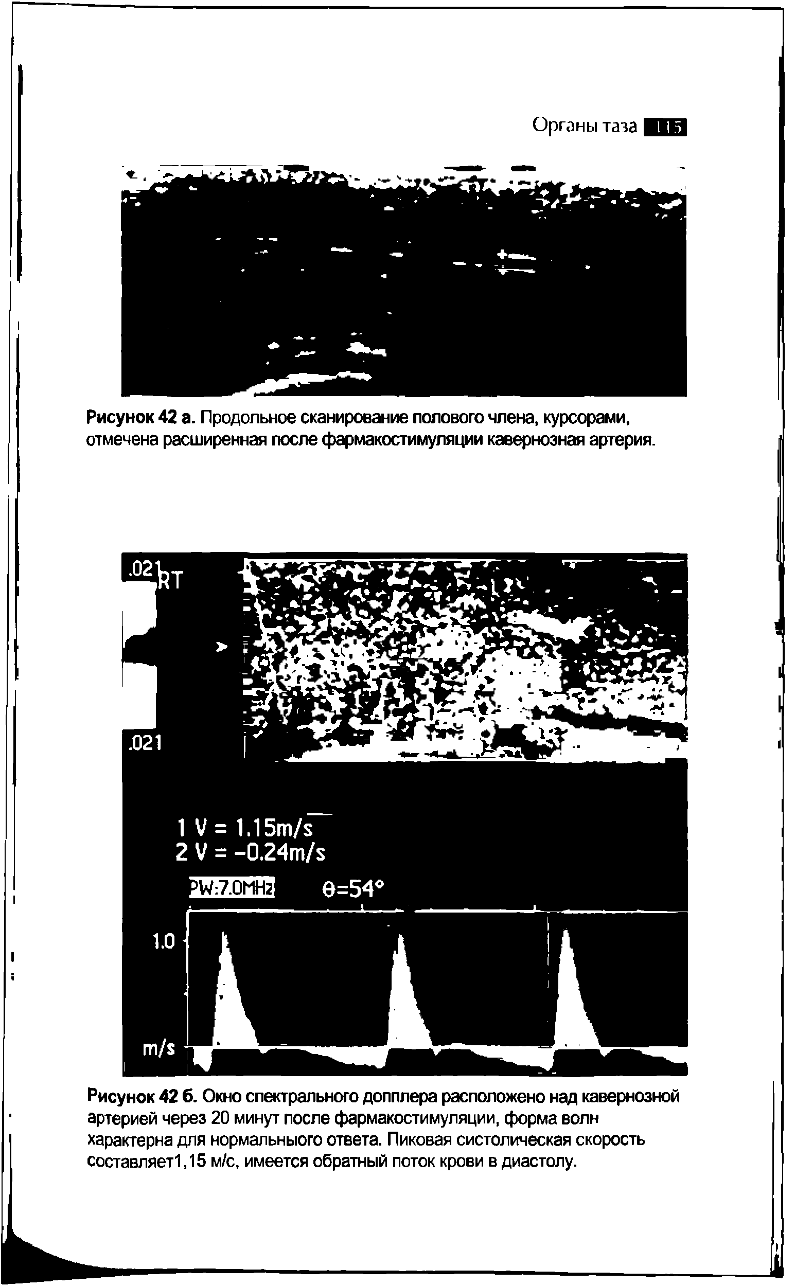 Рисунок 42 6. Окно спектрального допплера расположено над кавернозной артерией через 20 минут после фармакостимуляции, форма волн характерна для нормальныого ответа. Пиковая систолическая скорость составляет1,15 м/с, имеется обратный поток крови в диастолу.