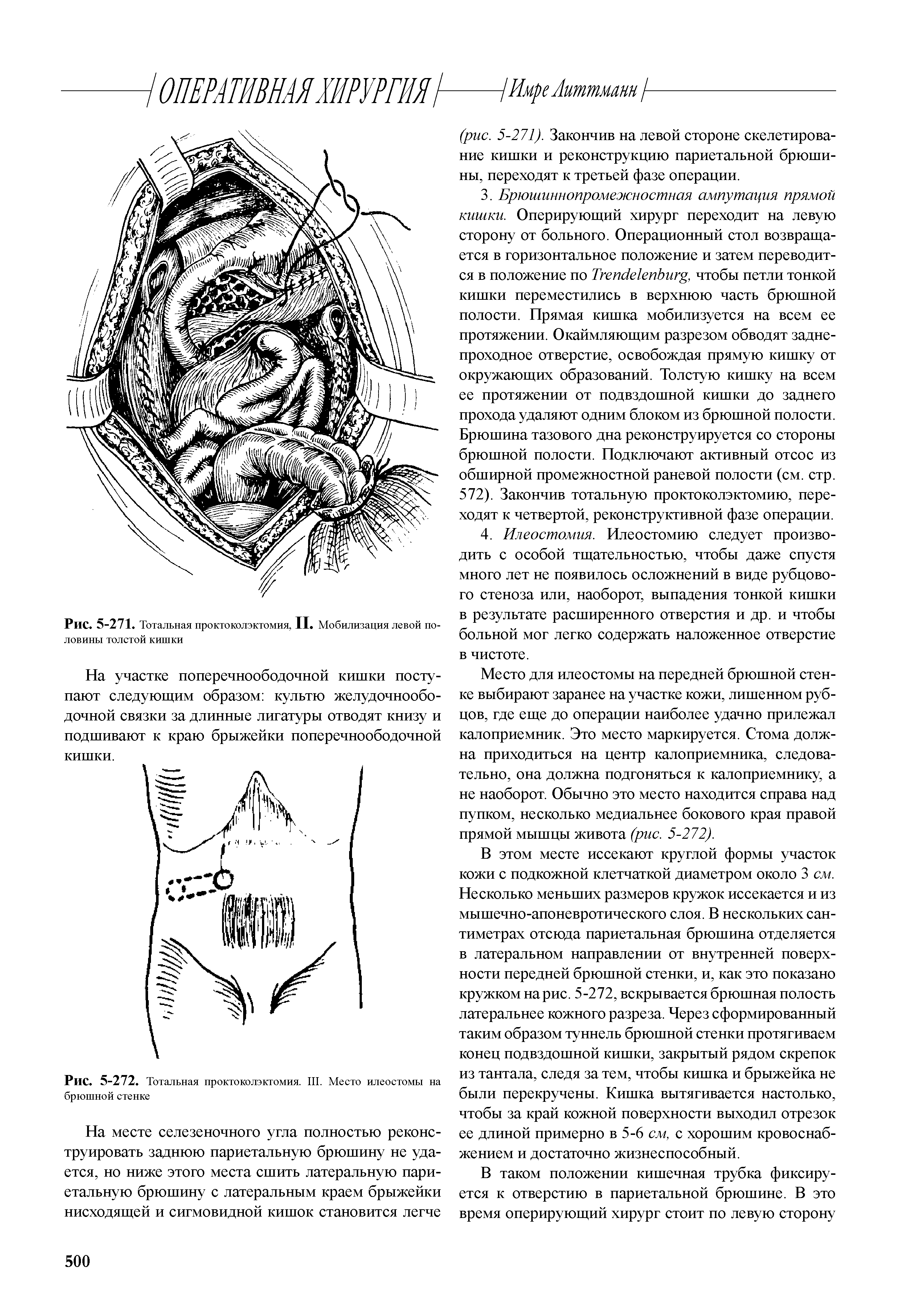 Рис. 5-272. Тотальная проктоколэктомия. III. Место илеостомы на брюшной стенке...