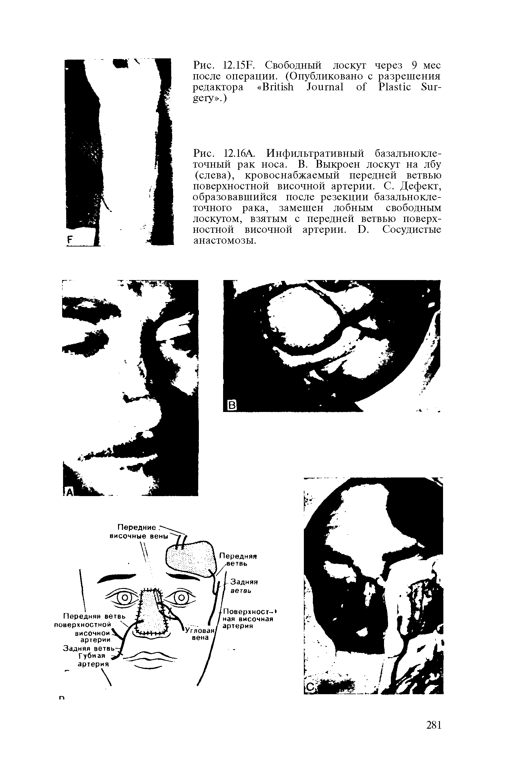 Рис. 12.16А. Инфильтративный базальноклеточный рак носа. В. Выкроен лоскут на лбу (слева), кровоснабжаемый передней ветвью поверхностной височной артерии. С. Дефект, образовавшийся после резекции базальноклеточного рака, замещен лобным свободным лоскутом, взятым с передней ветвью поверхностной височной артерии. И. Сосудистые анастомозы.