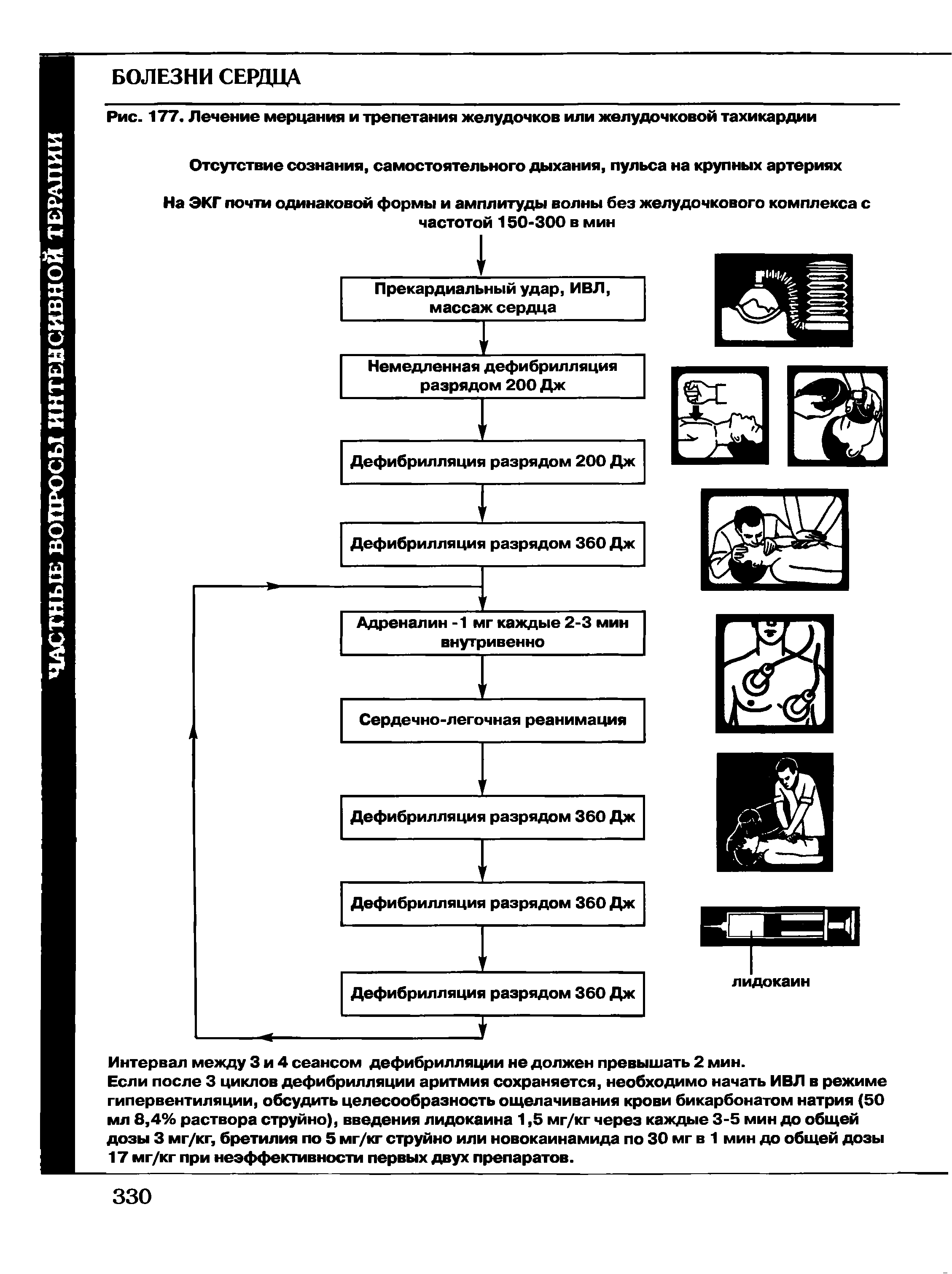 Рис. 177. Лечение мерцания и трепетания желудочков или желудочковой тахикардии...