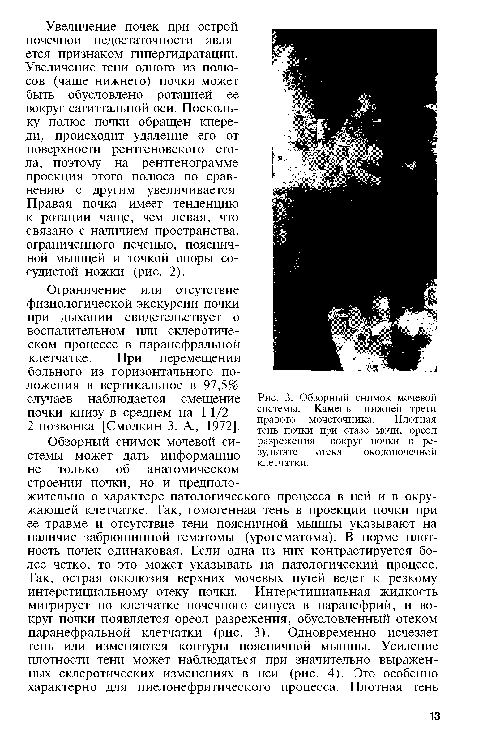 Рис. 3. Обзорный снимок мочевой системы. Камень нижней трети правого мочеточника. Плотная тень почки при стазе мочи, ореол разрежения вокруг почки в результате отека околопочечной клетчатки.