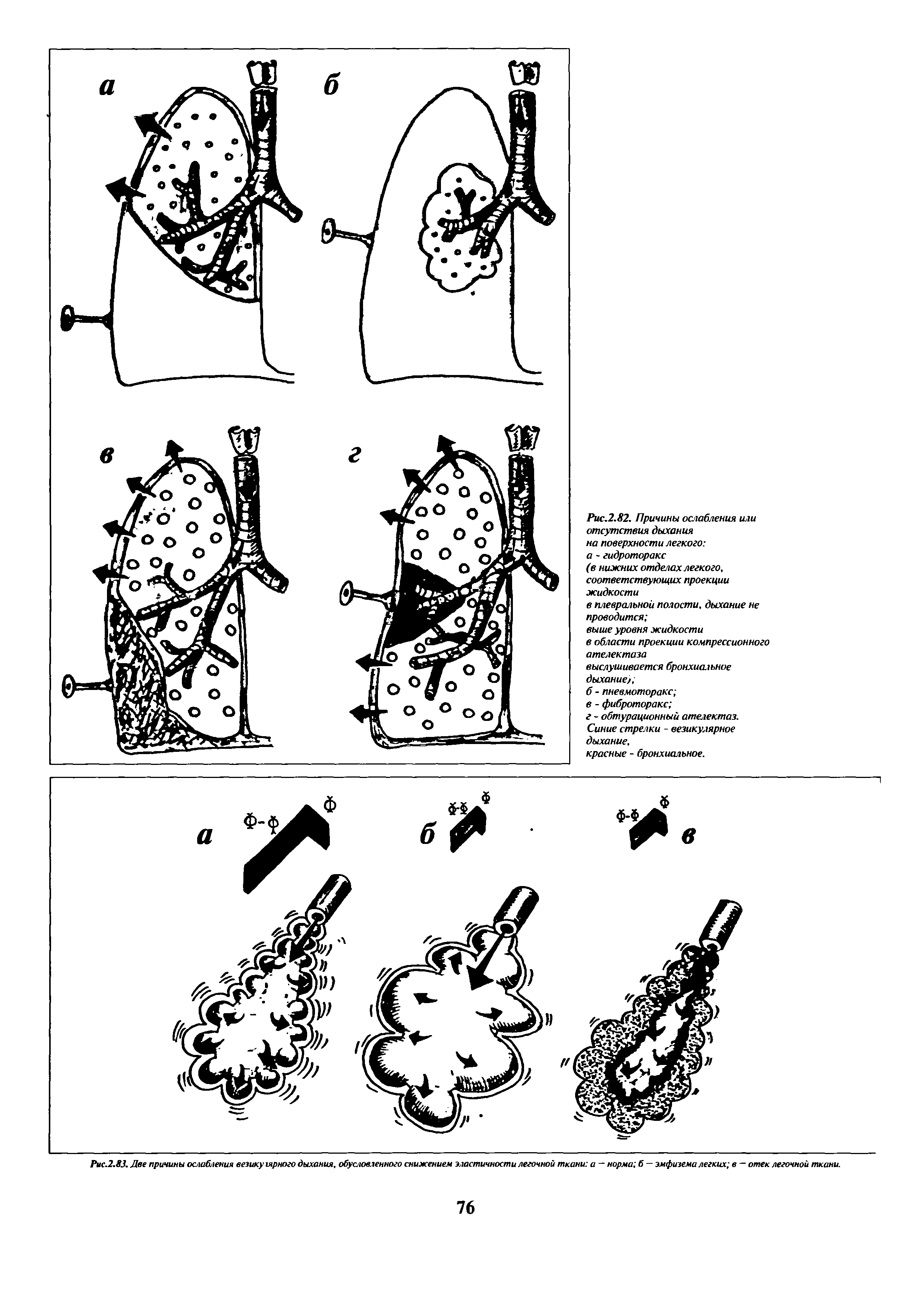 Рис.2.83. Две причины ослабления везику гярного дыхания, обусловленного снижением эластичности легочной ткани а — норма б — эмфизема легких в — отек легочной ткани.