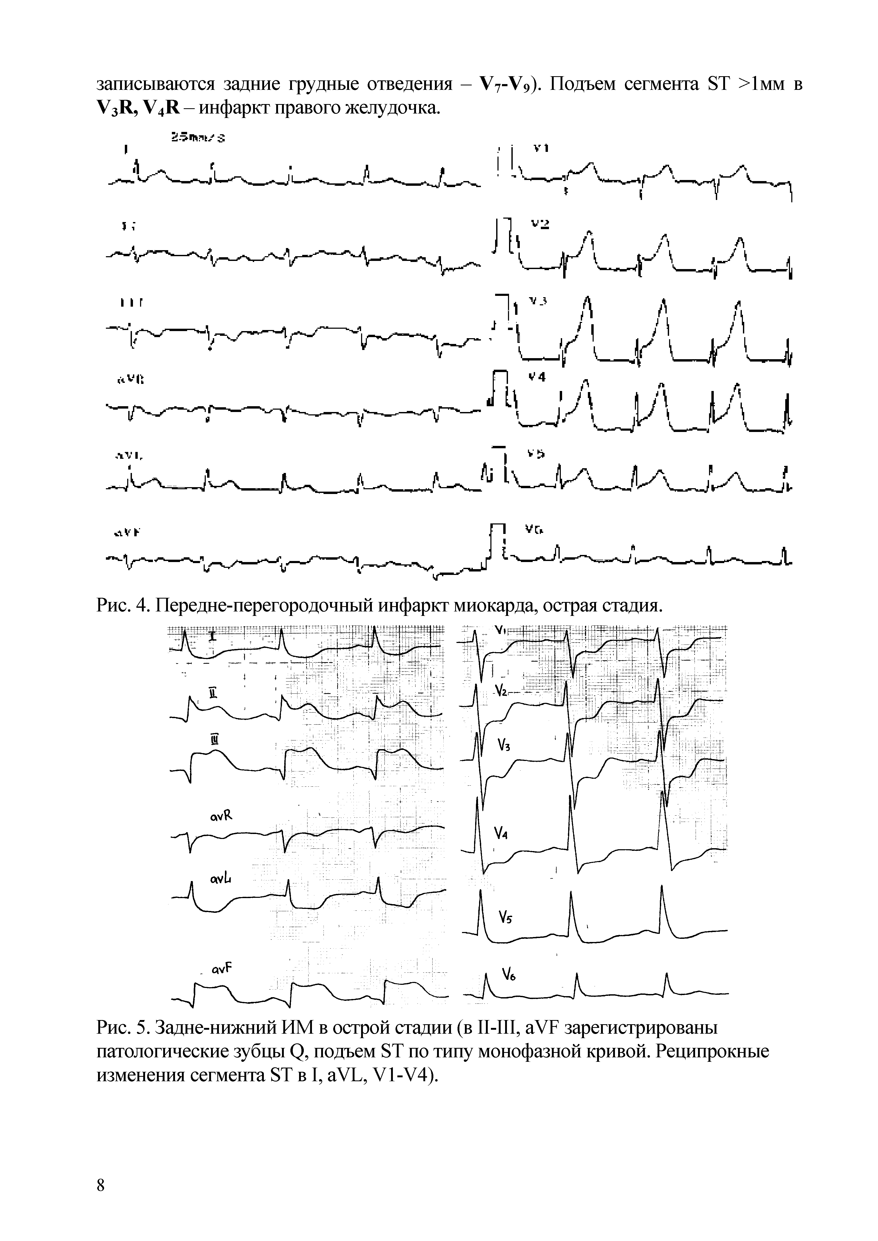 Рис. 4. Передне-перегородочный инфаркт миокарда, острая стадия.