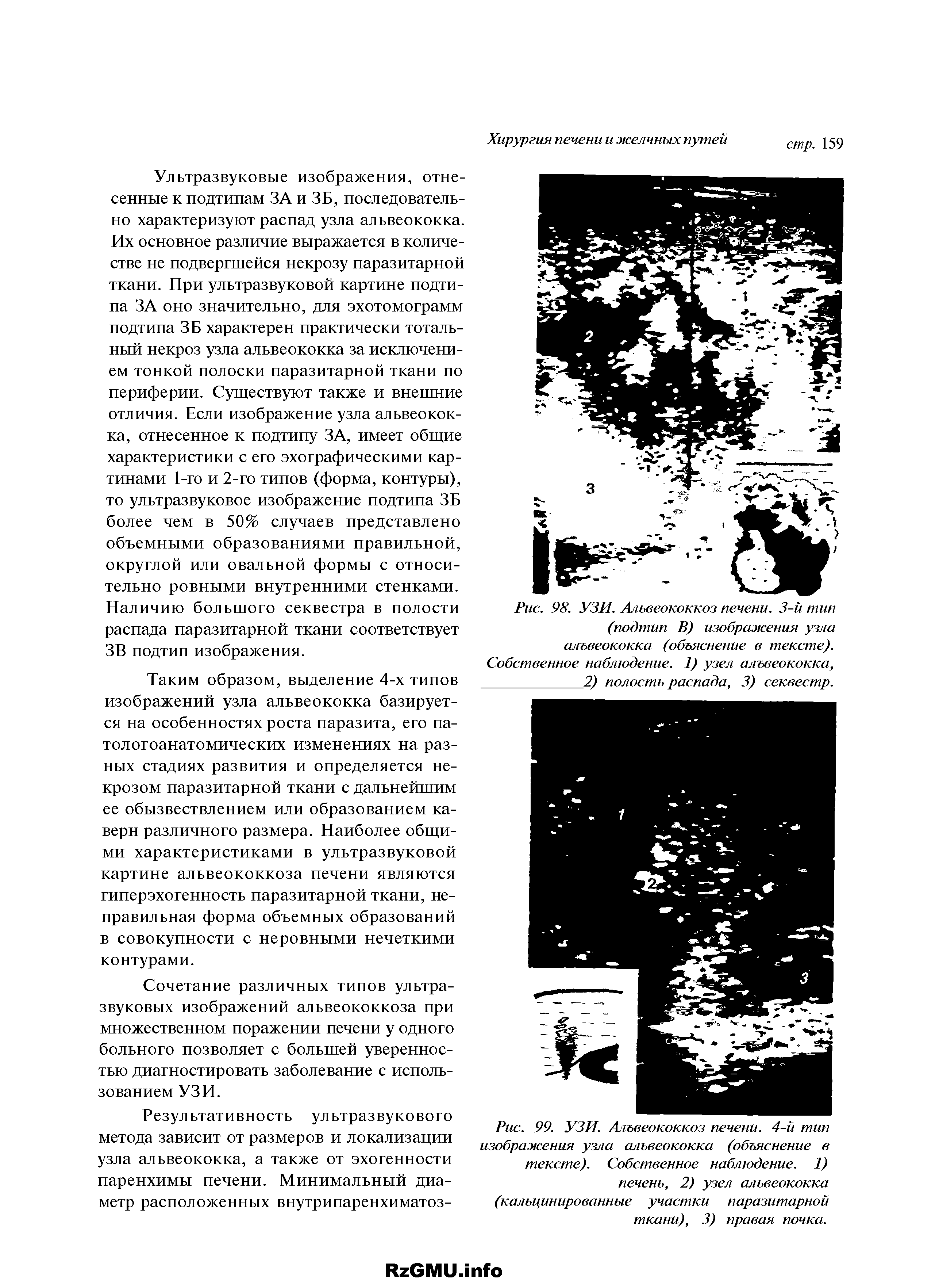 Рис. 98. УЗИ. Альвеококкоз печени. 3-й тип (подтип В) изображения узла альвеококка (объяснение в тексте). Собственное наблюдение. 1) узел альвеококка, 2) полость распада, 3) секвестр.