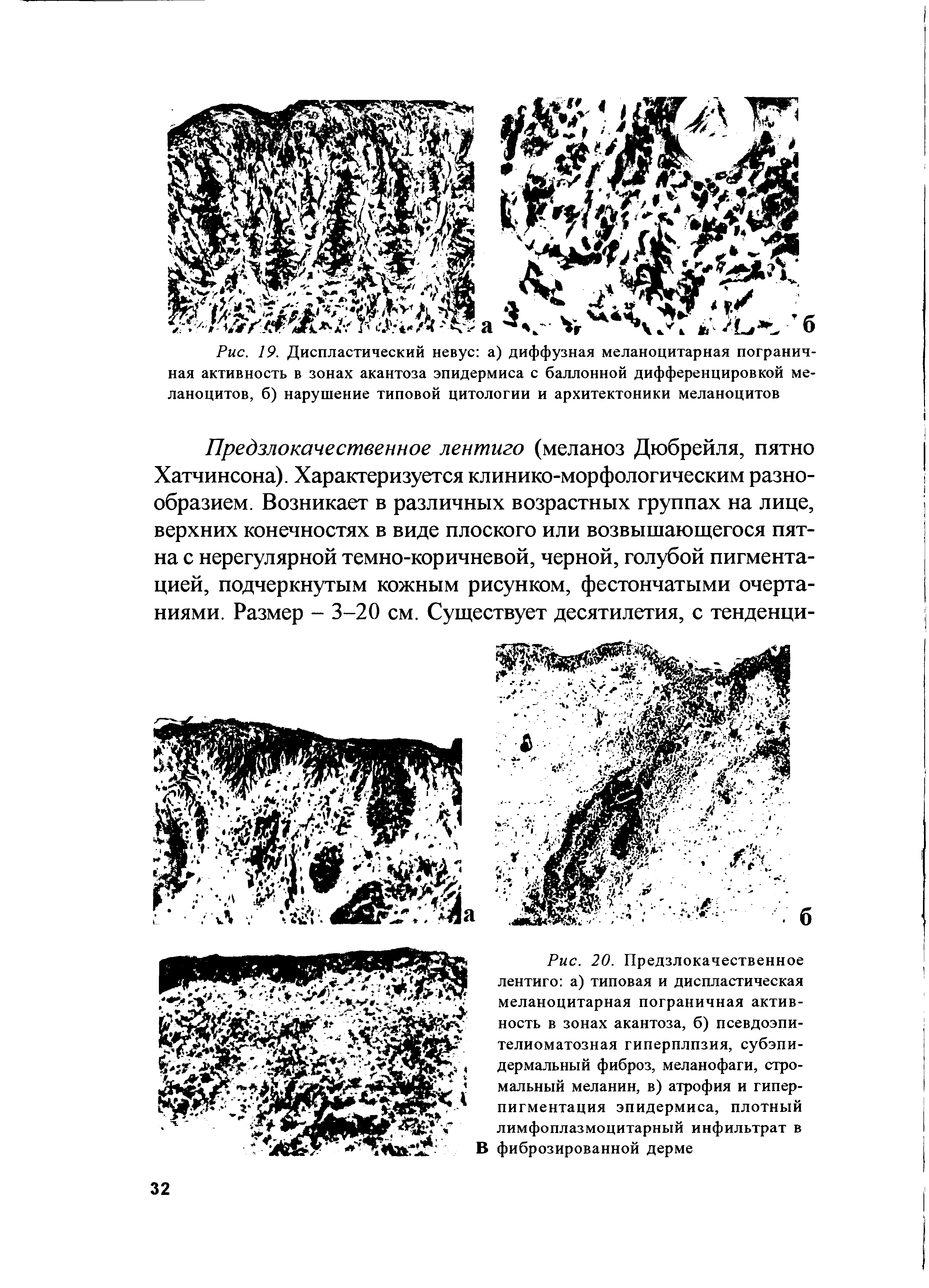 Рис. 20. Предзлокачественное лентиго а) типовая и диспластическая меланоцитарная пограничная активность в зонах акантоза, б) псевдоэпи-телиоматозная гиперплпзия, субэпидермальный фиброз, меланофаги, стромальный меланин, в) атрофия и гиперпигментация эпидермиса, плотный лимфоплазмоцитарный инфильтрат в В фиброзированной дерме...