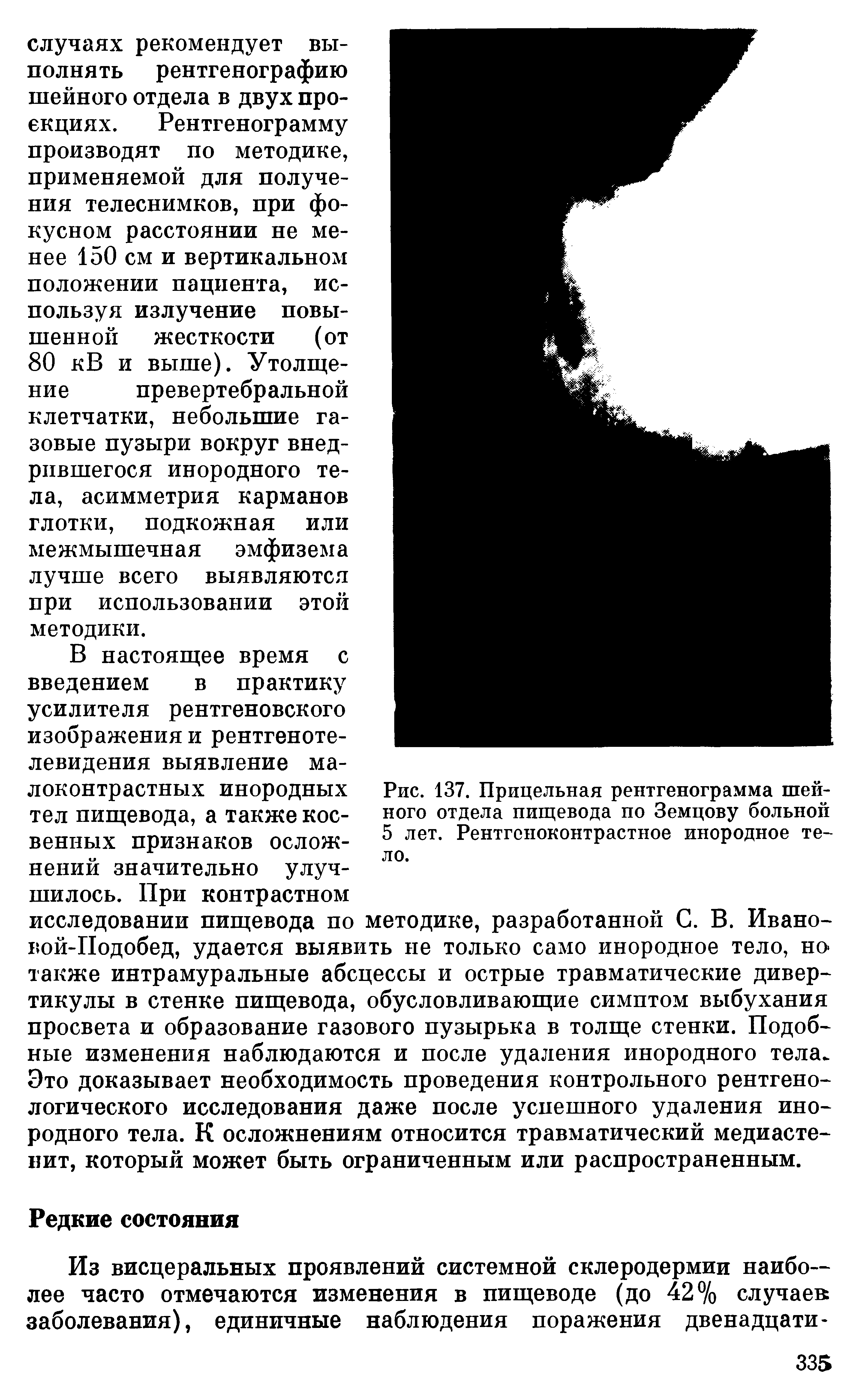 Рис. 137. Прицельная рентгенограмма шейного отдела пищевода по Земцову больной 5 лет. Рентгеноконтрастное инородное тело.